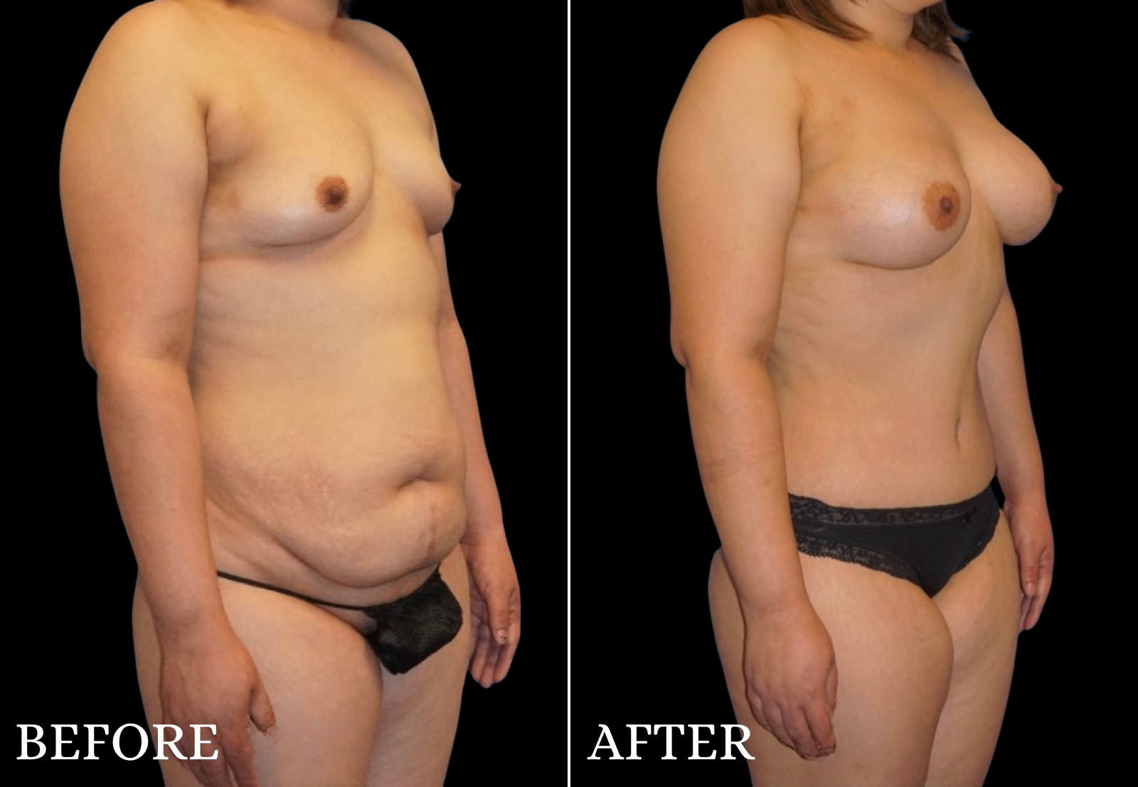 Mommy Makeover Before & After Gallery - Patient 326033 - Image 2