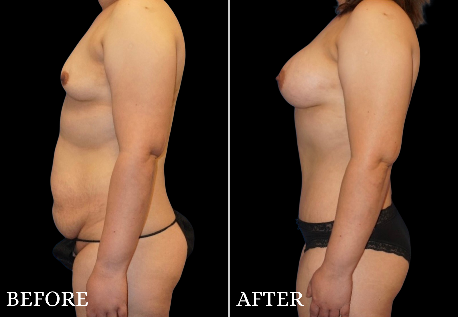 Mommy Makeover Before & After Gallery - Patient 326033 - Image 4