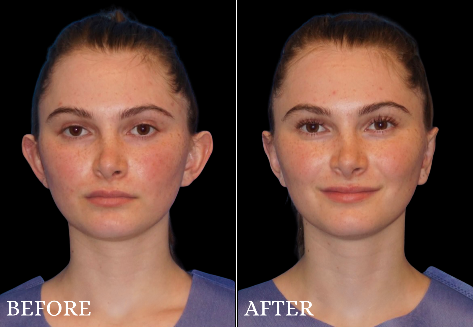 Otoplasty Before & After Gallery - Patient 304524 - Image 1
