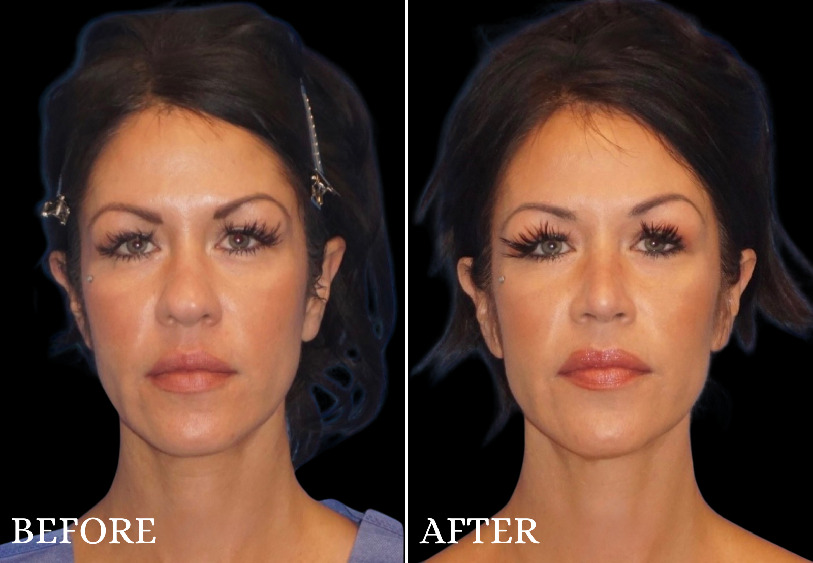 Rhinoplasty Before & After Gallery - Patient 154509 - Image 1