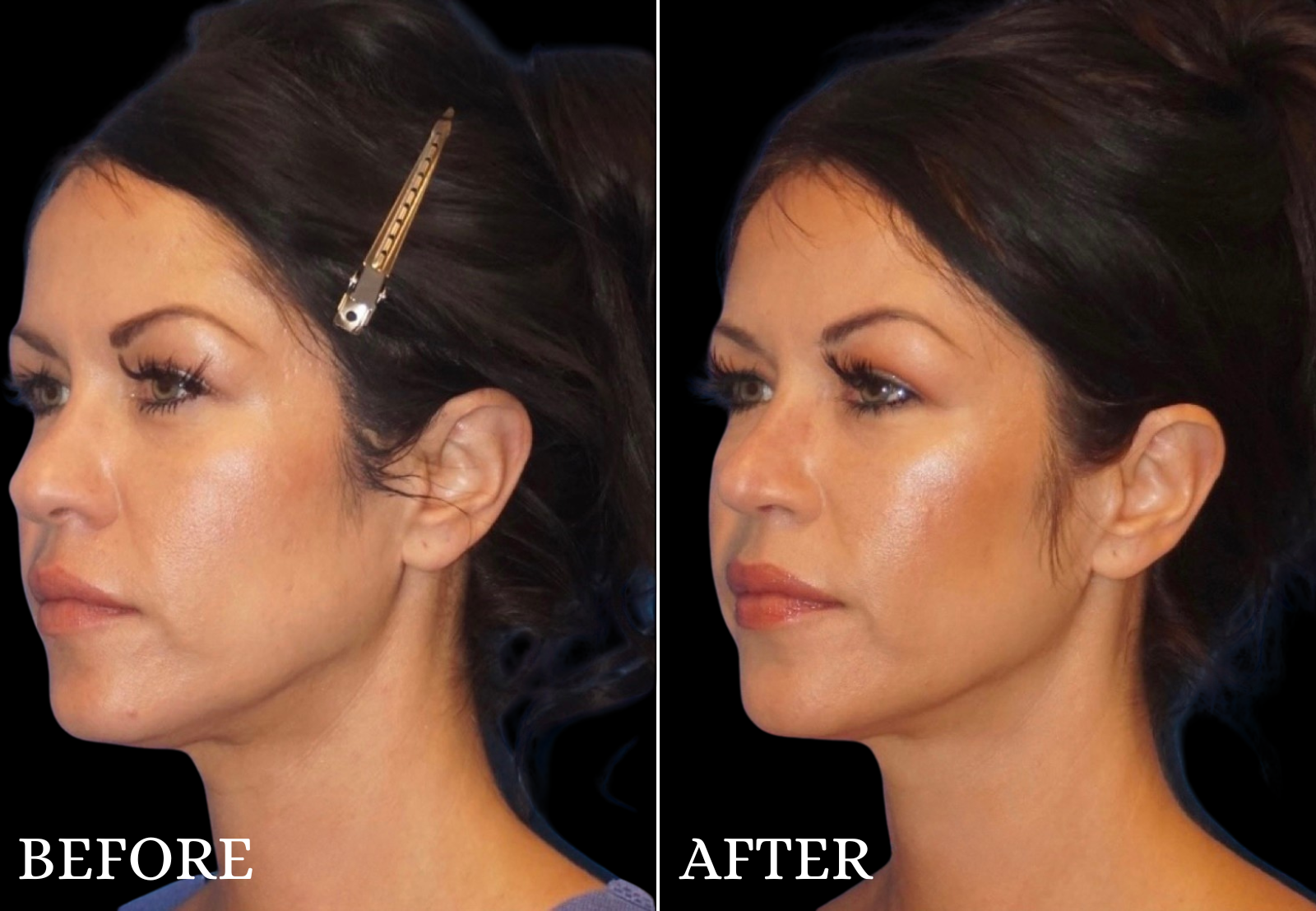 Rhinoplasty Before & After Gallery - Patient 154509 - Image 2