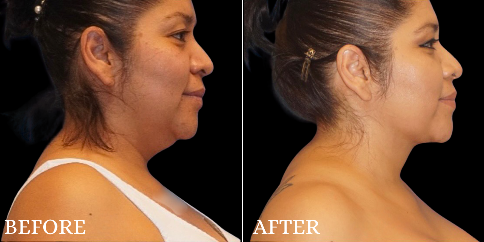 Chin Liposuction Before & After Gallery - Patient 111355 - Image 1