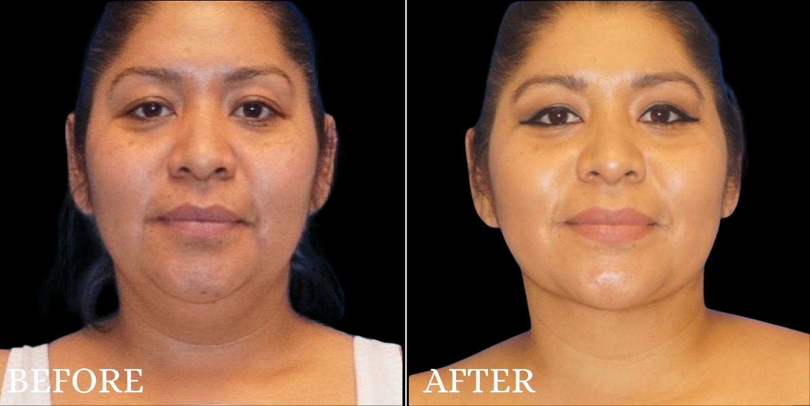 Chin Liposuction Before & After Gallery - Patient 111355 - Image 3