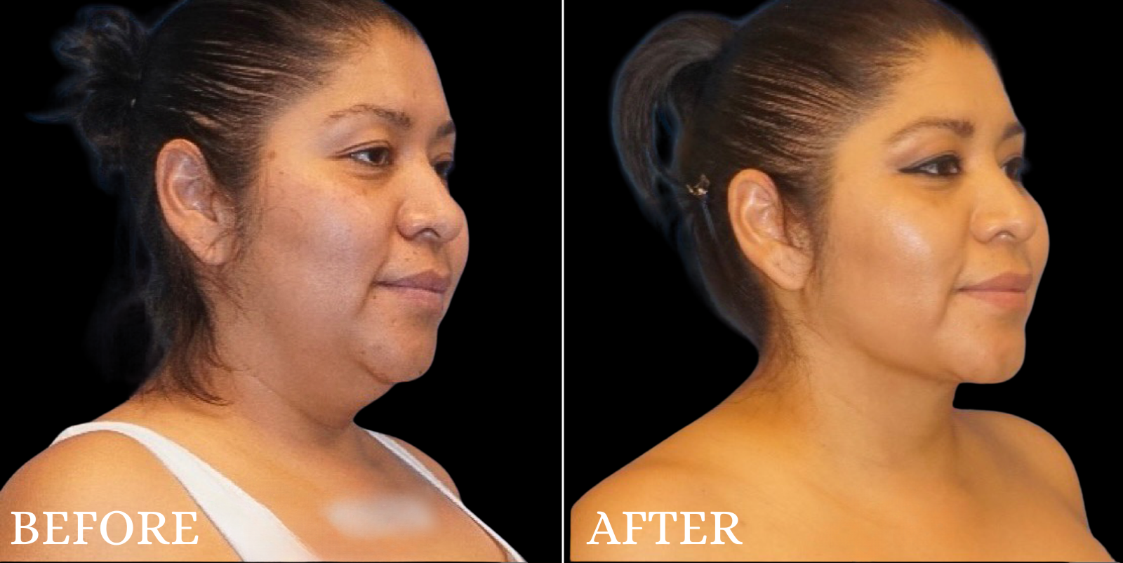 Chin Liposuction Before & After Gallery - Patient 111355 - Image 2