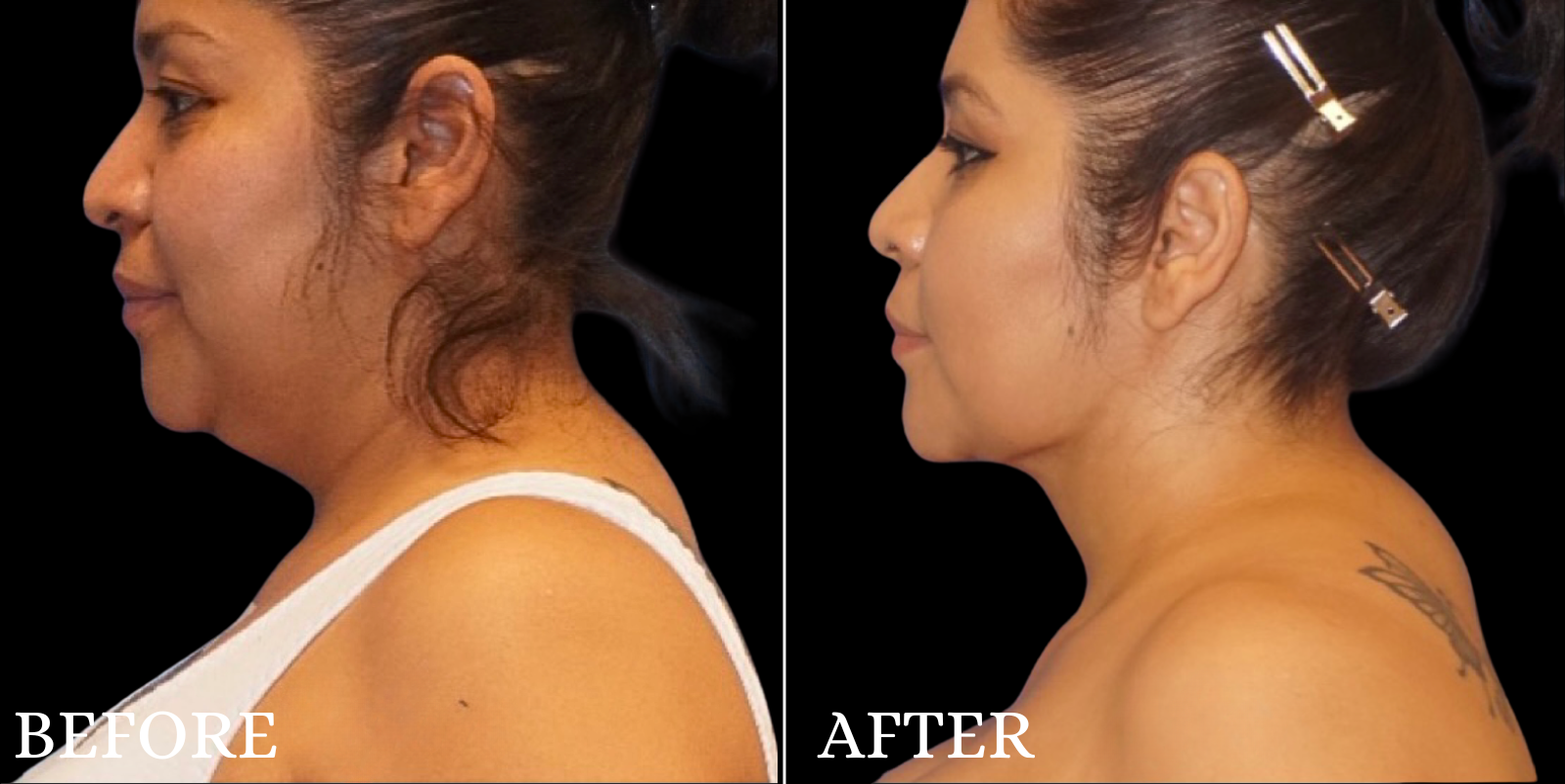 Chin Liposuction Before & After Gallery - Patient 111355 - Image 4