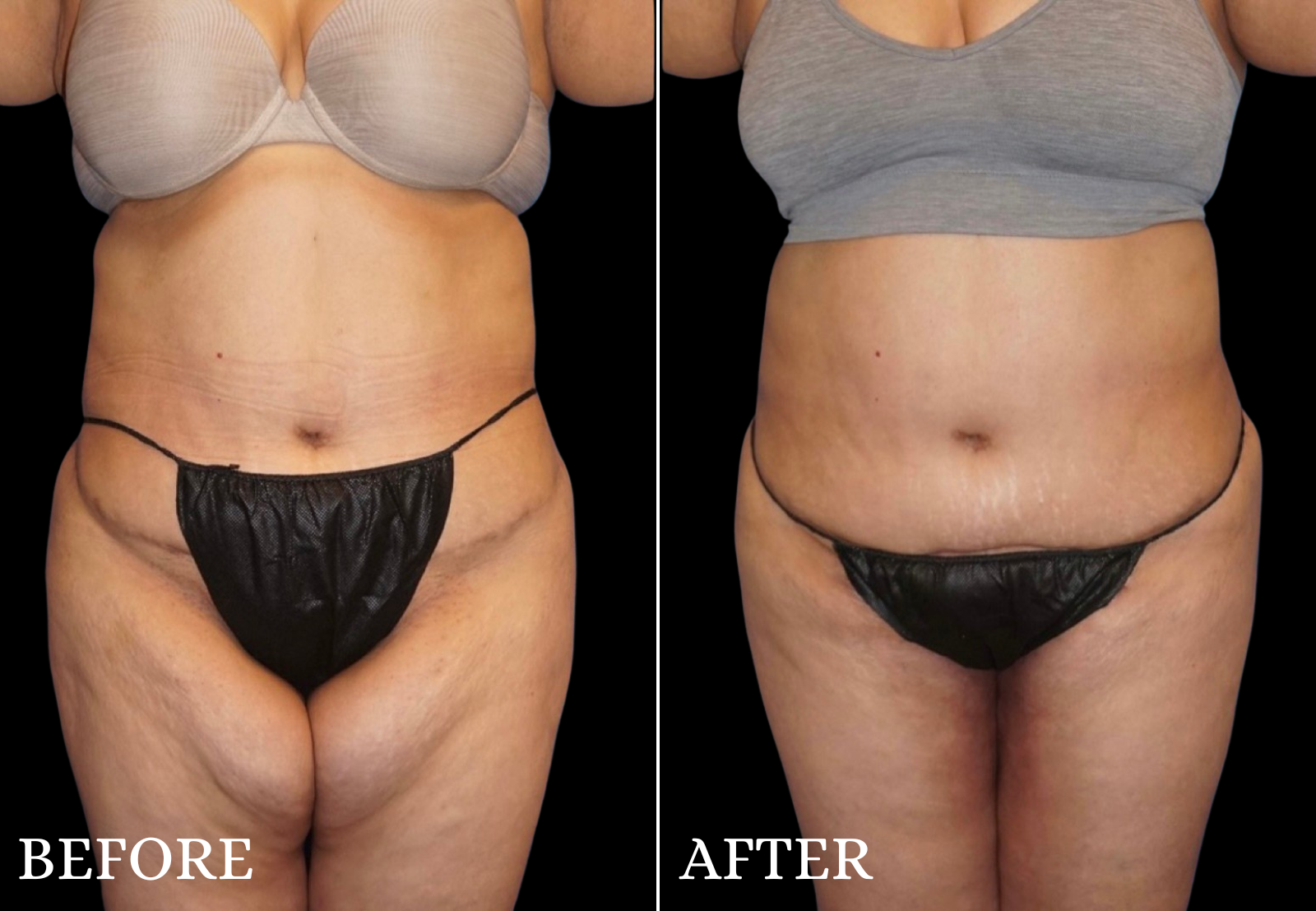 Thigh Lift Before & After Gallery - Patient 274121 - Image 1