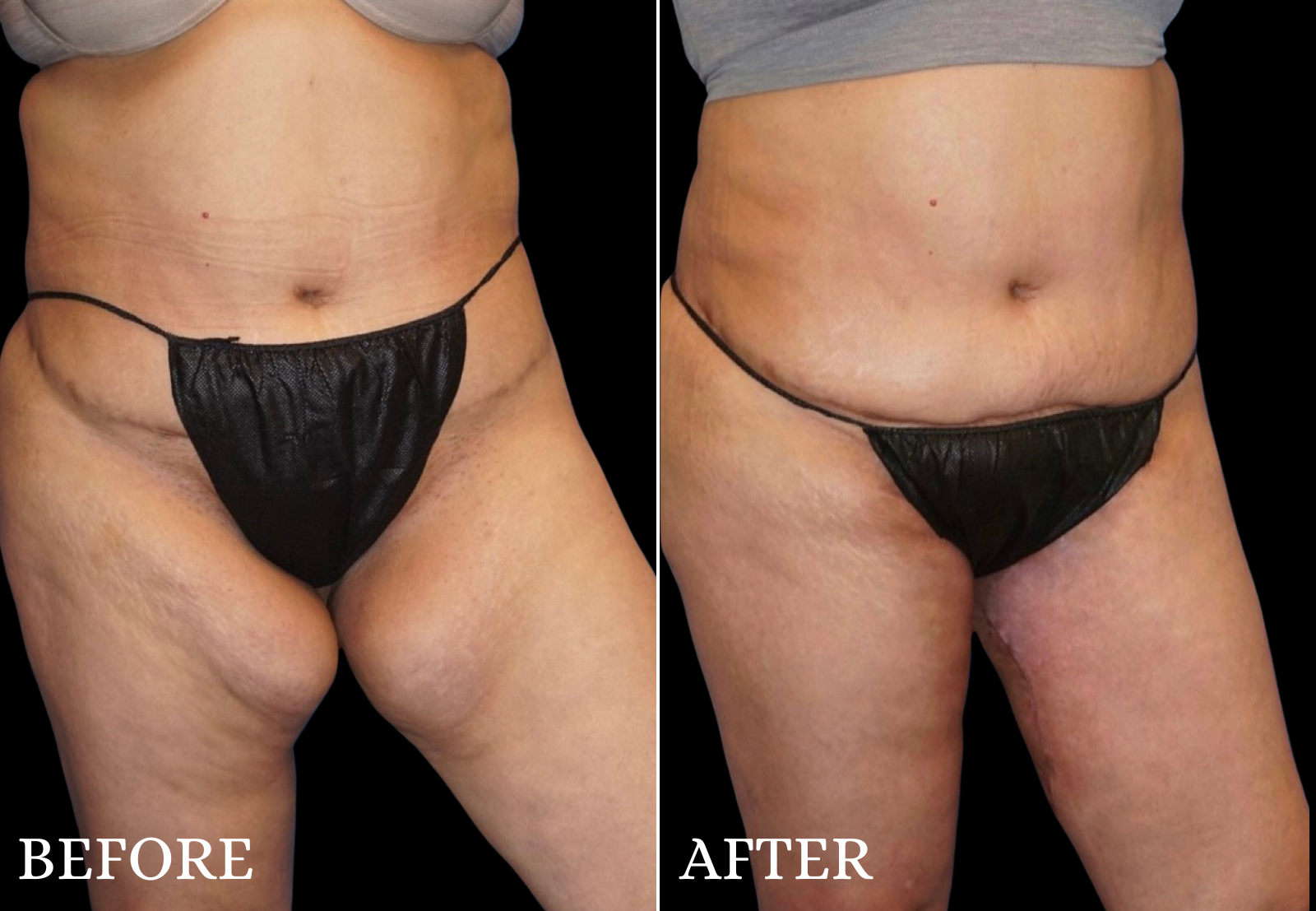 Thigh Lift Before & After Gallery - Patient 274121 - Image 3