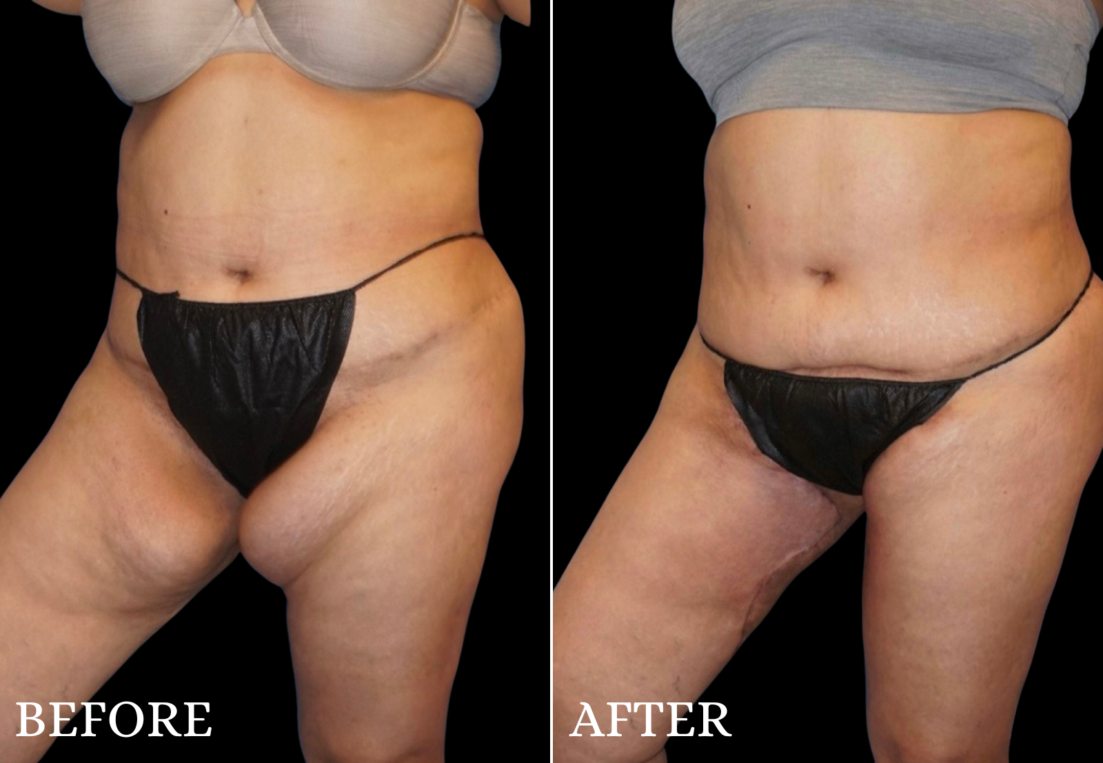 Thigh Lift Before & After Gallery - Patient 274121 - Image 2