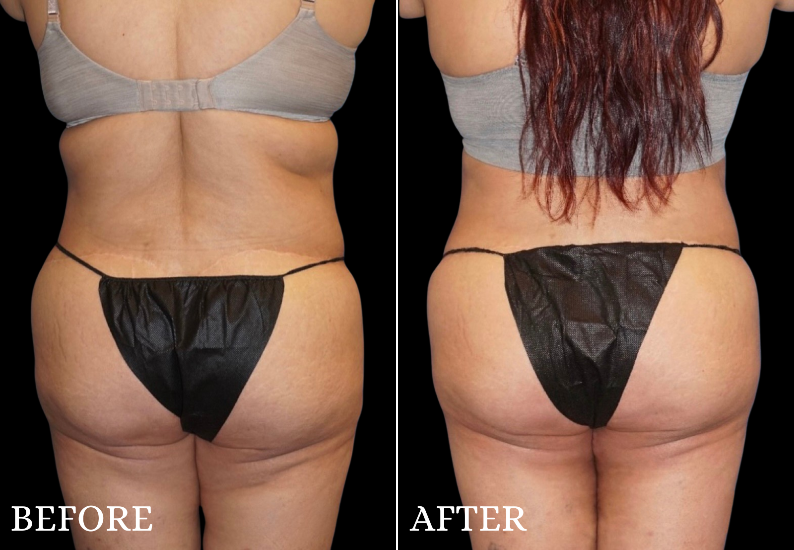 Thigh Lift Before & After Gallery - Patient 274121 - Image 4