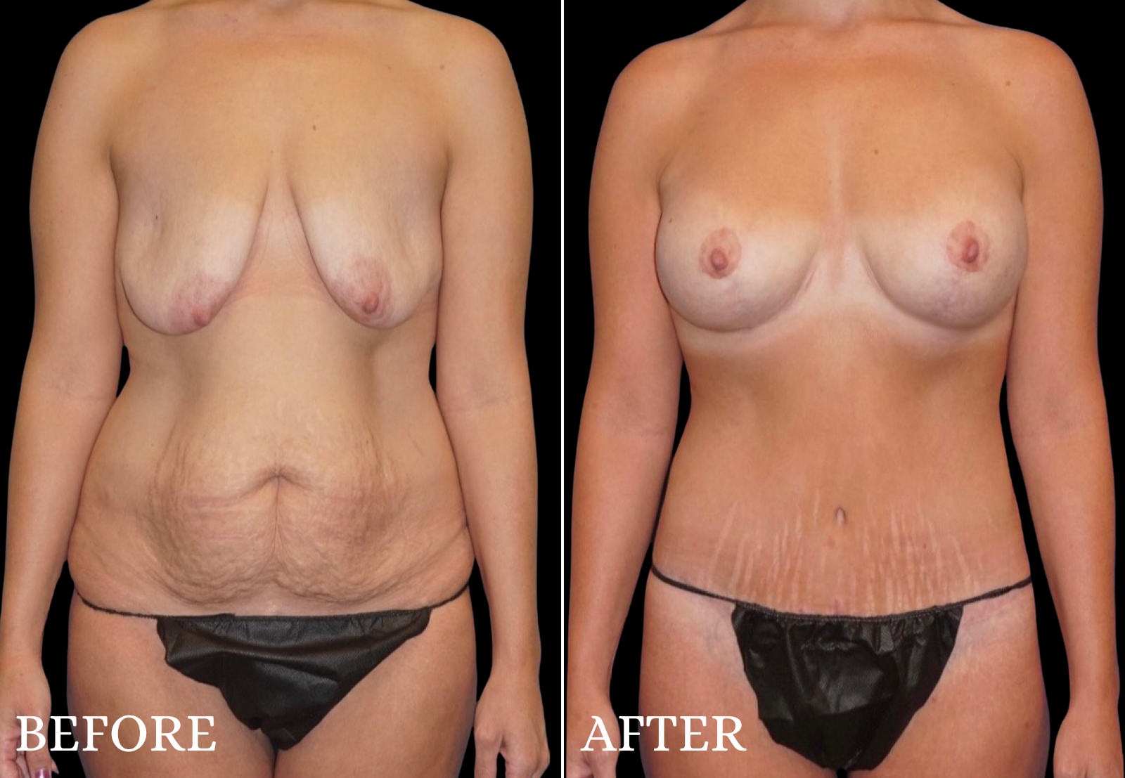 Tummy Tuck Before & After Gallery - Patient 491724 - Image 1