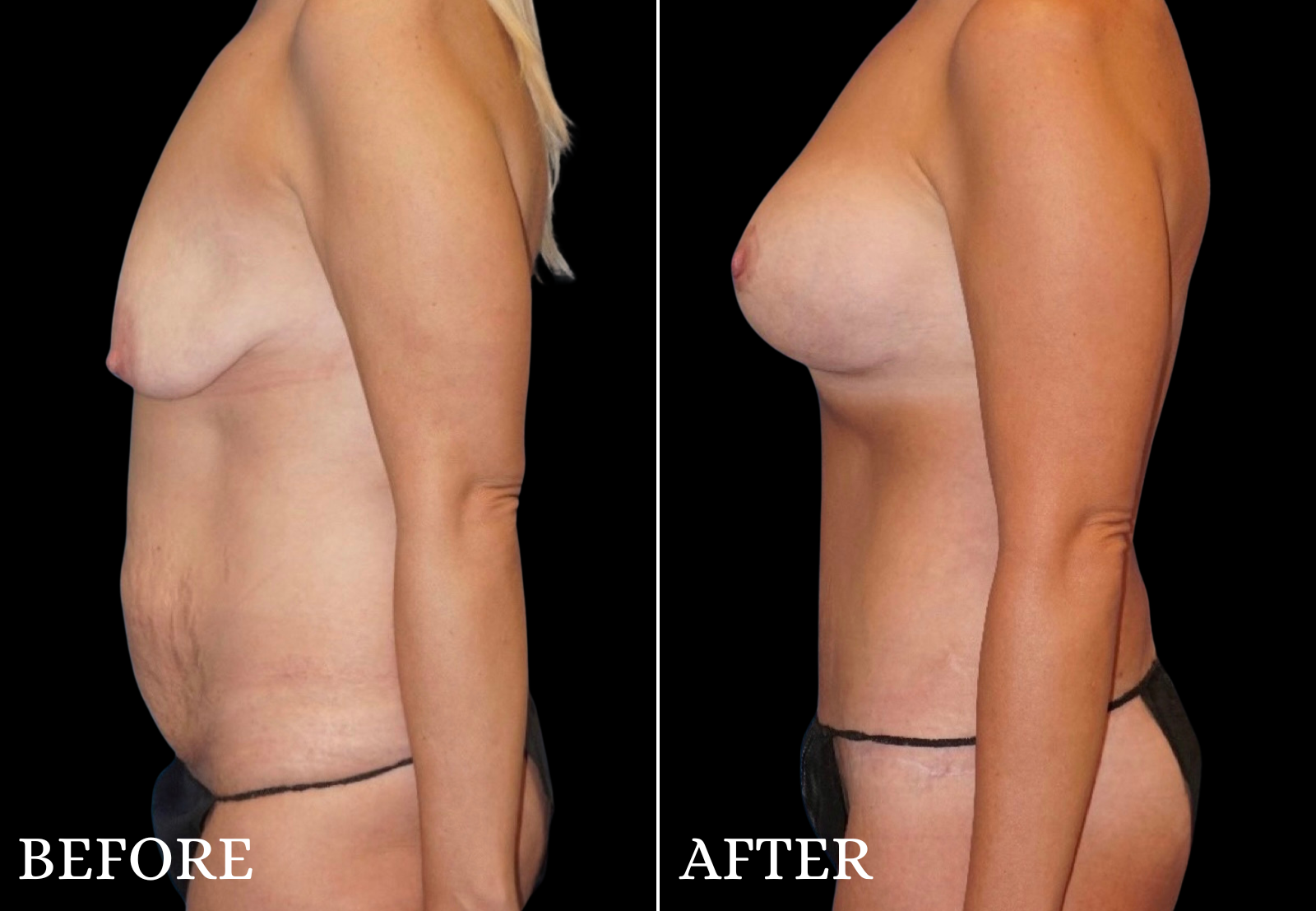 Tummy Tuck Before & After Gallery - Patient 491724 - Image 5
