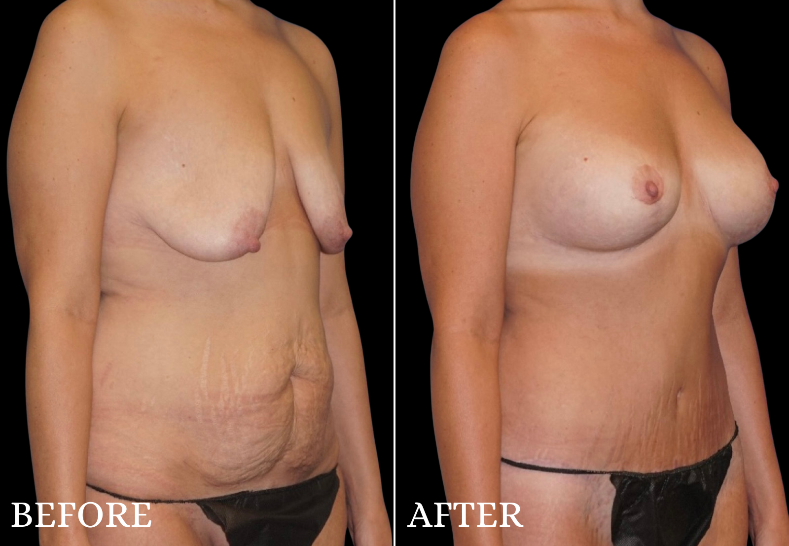 Tummy Tuck Before & After Gallery - Patient 491724 - Image 2