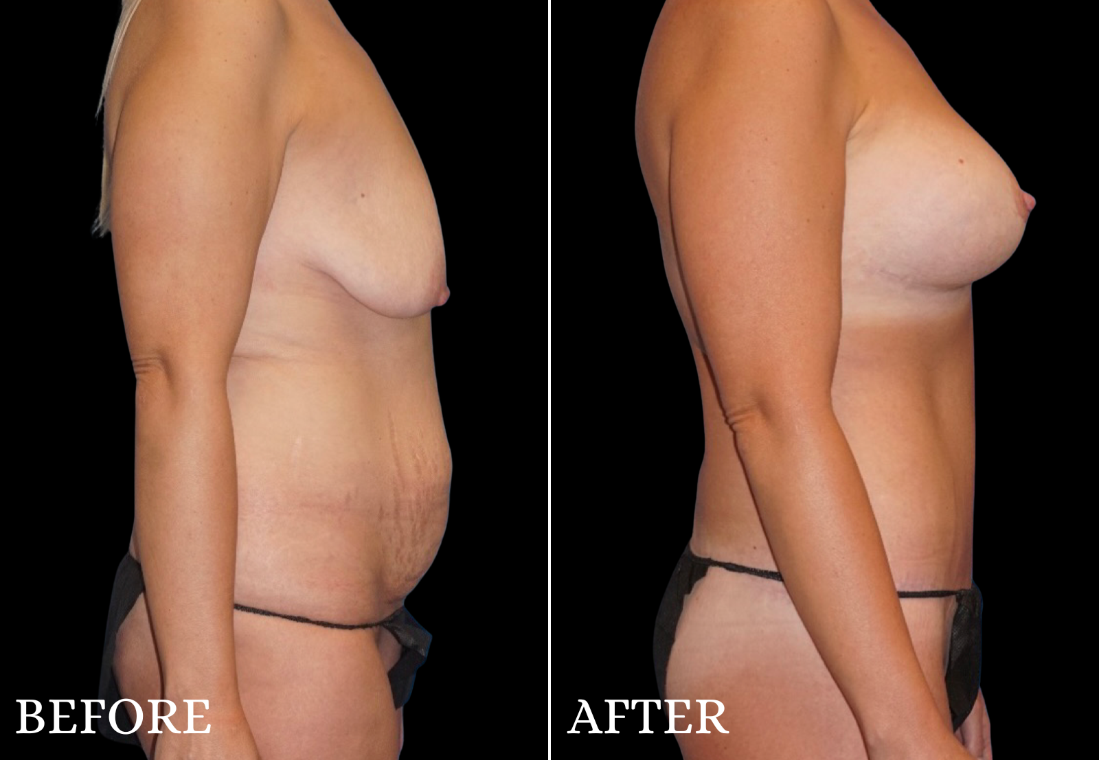 Tummy Tuck Before & After Gallery - Patient 491724 - Image 3