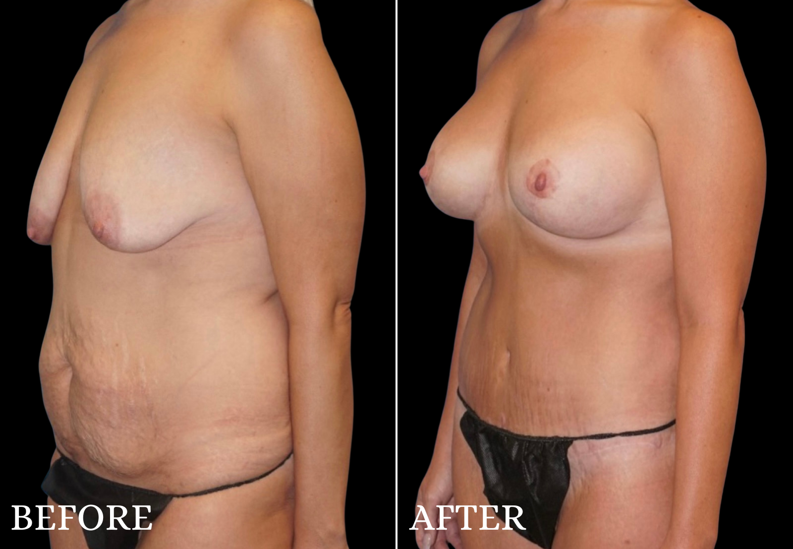 Tummy Tuck Before & After Gallery - Patient 491724 - Image 4