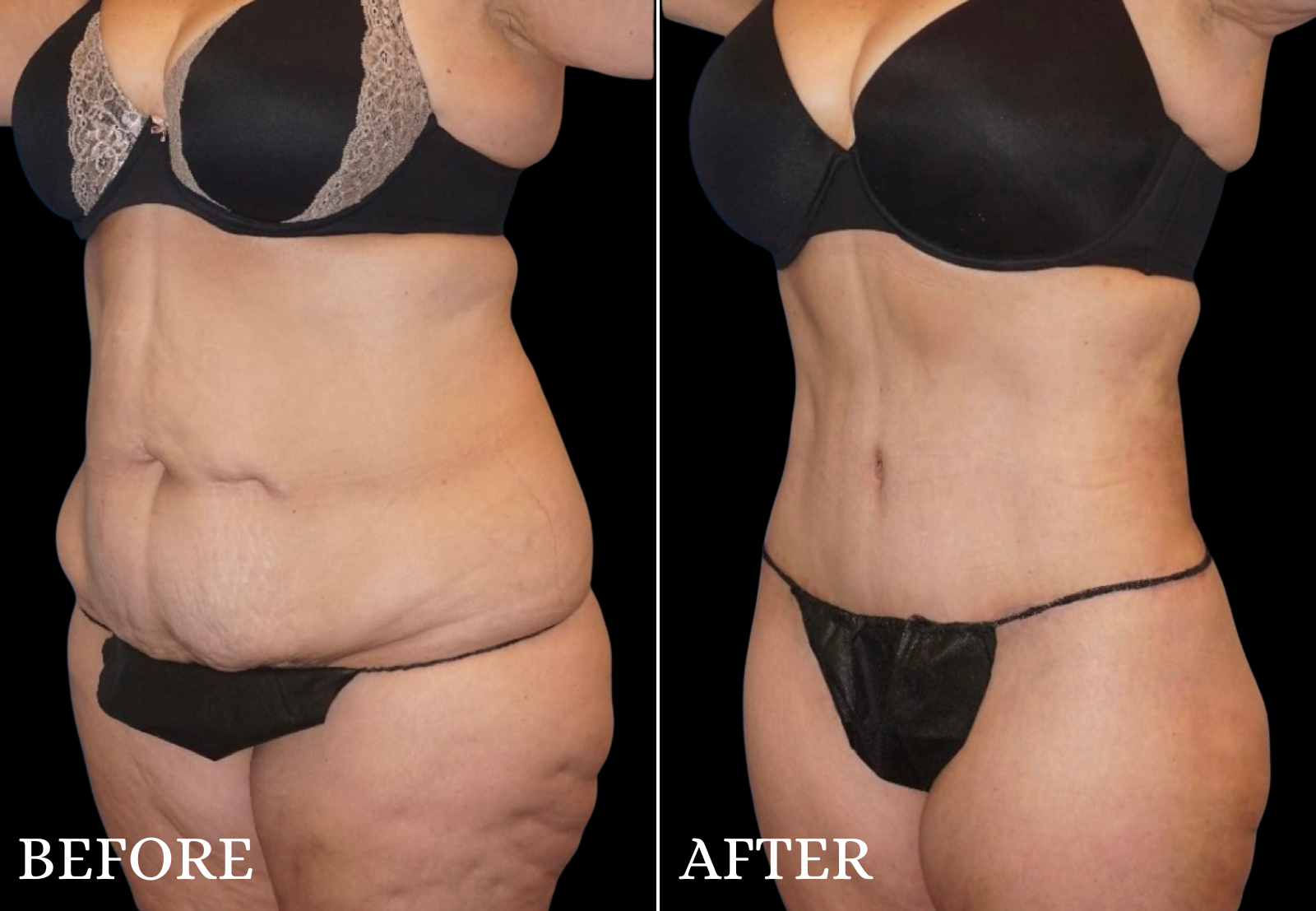 Tummy Tuck Before & After Gallery - Patient 501282 - Image 2
