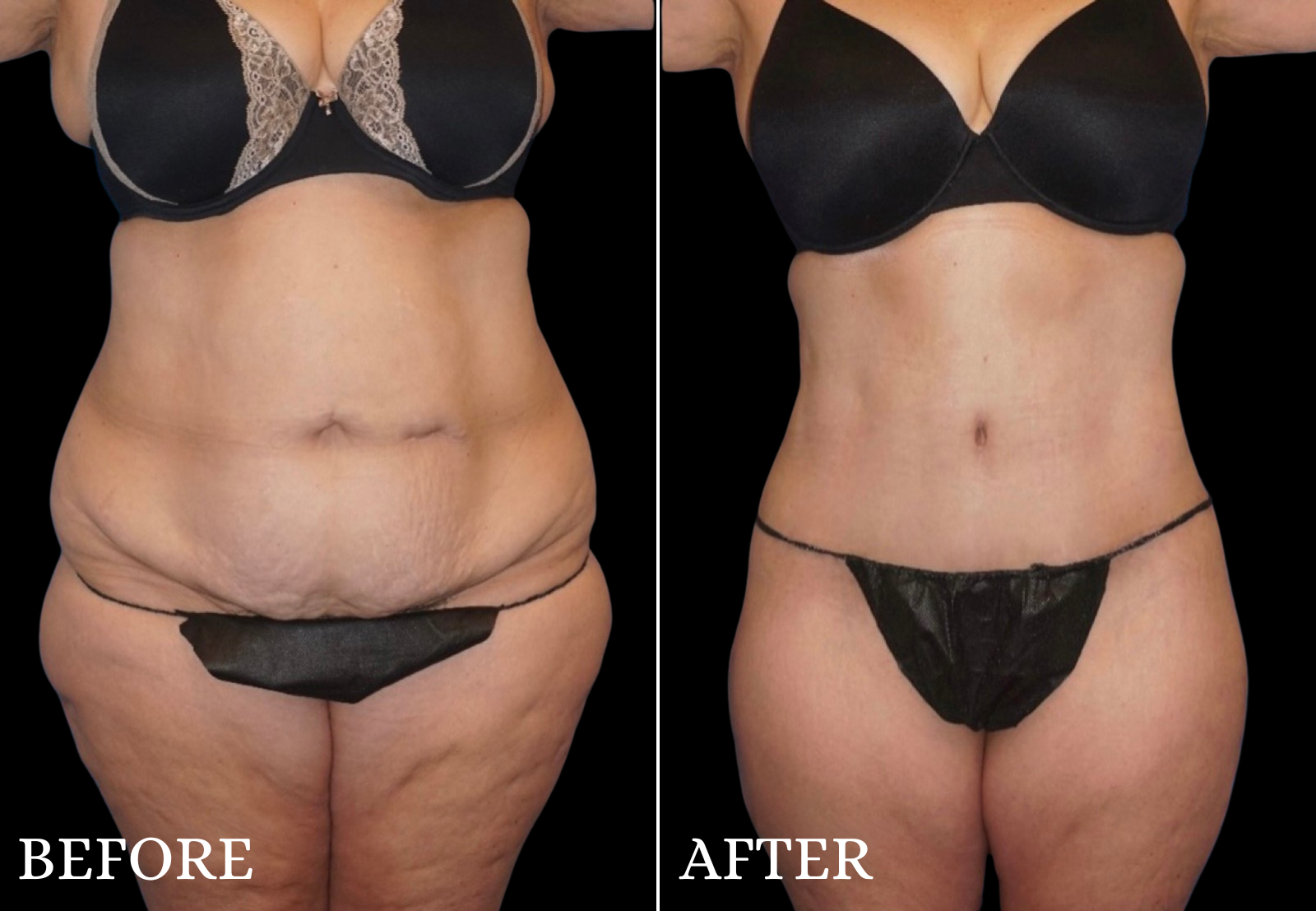 Tummy Tuck Before & After Gallery - Patient 501282 - Image 1