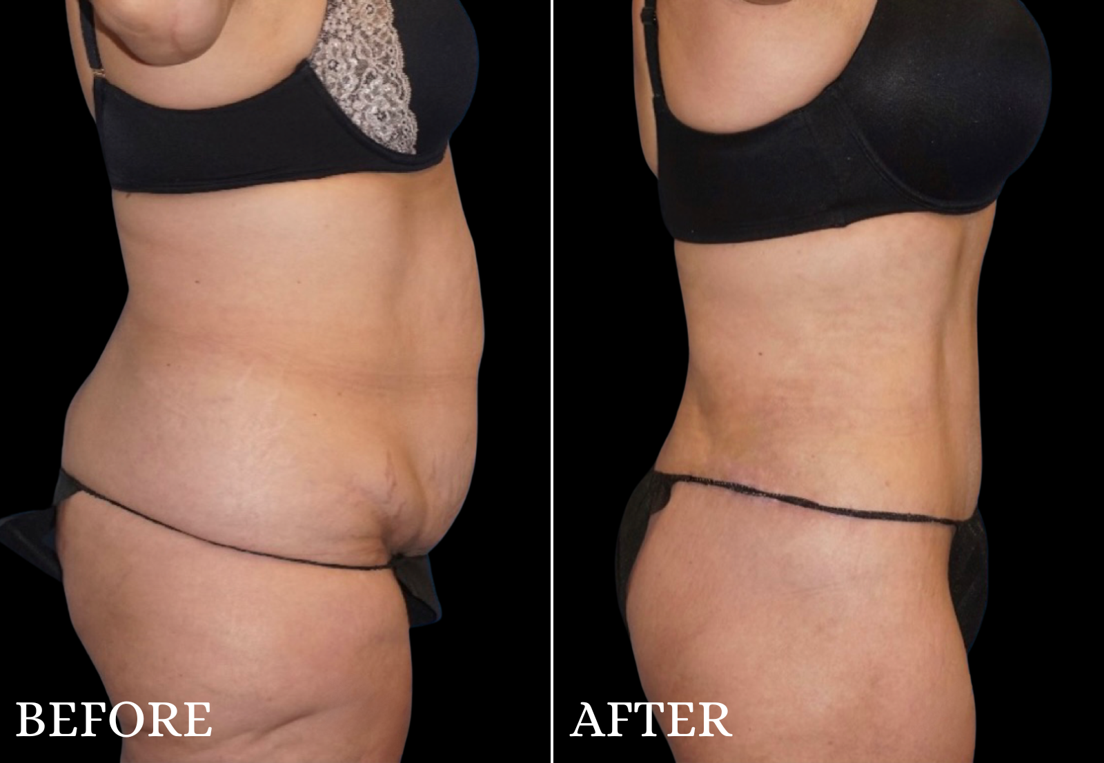 Tummy Tuck Before & After Gallery - Patient 501282 - Image 3