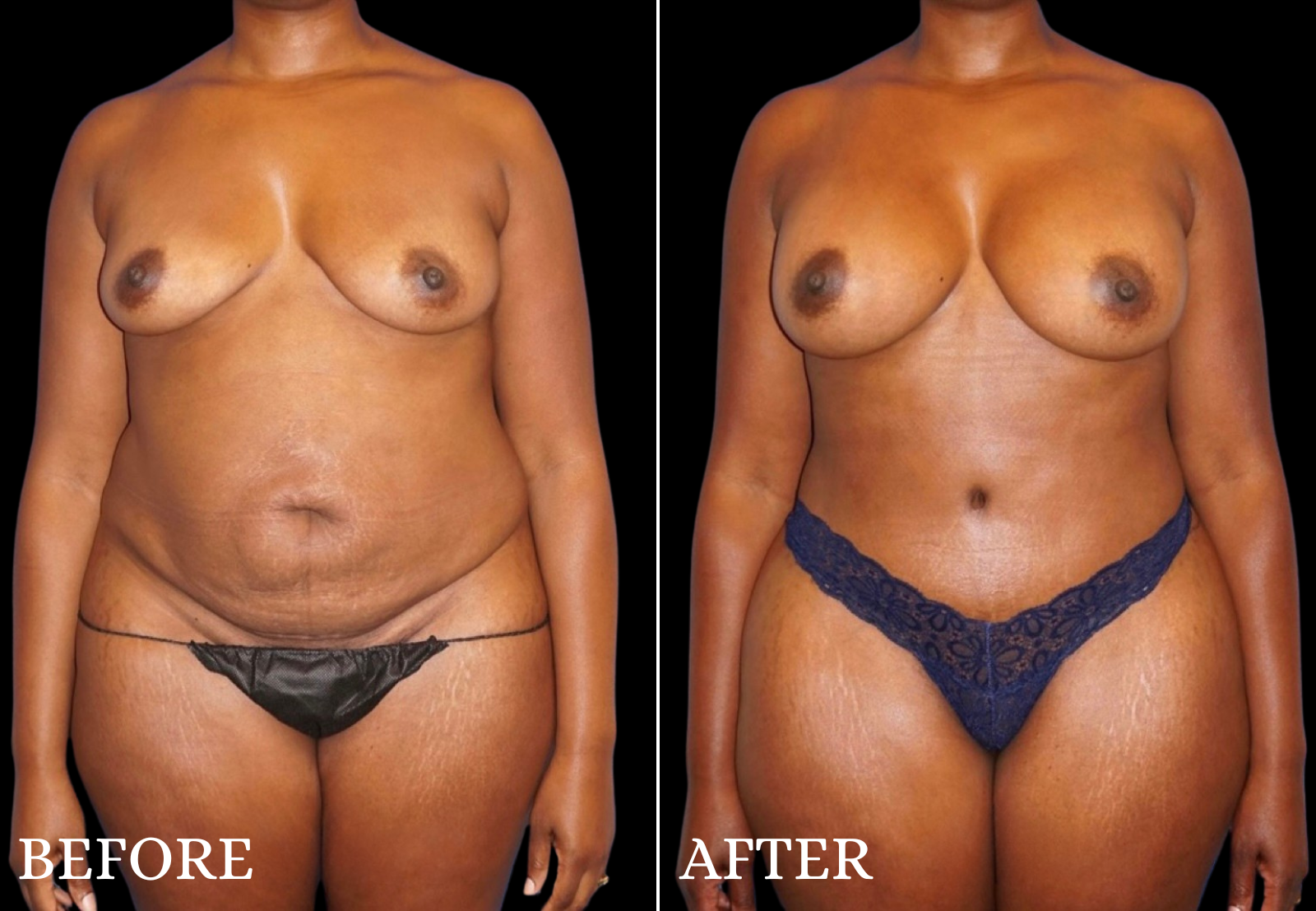 Tummy Tuck Before & After Gallery - Patient 305164 - Image 1