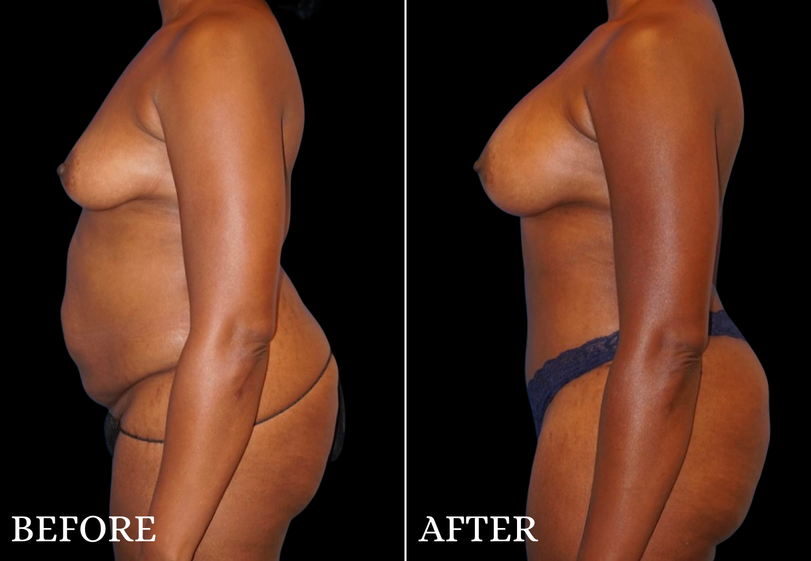 Tummy Tuck Before & After Gallery - Patient 305164 - Image 5