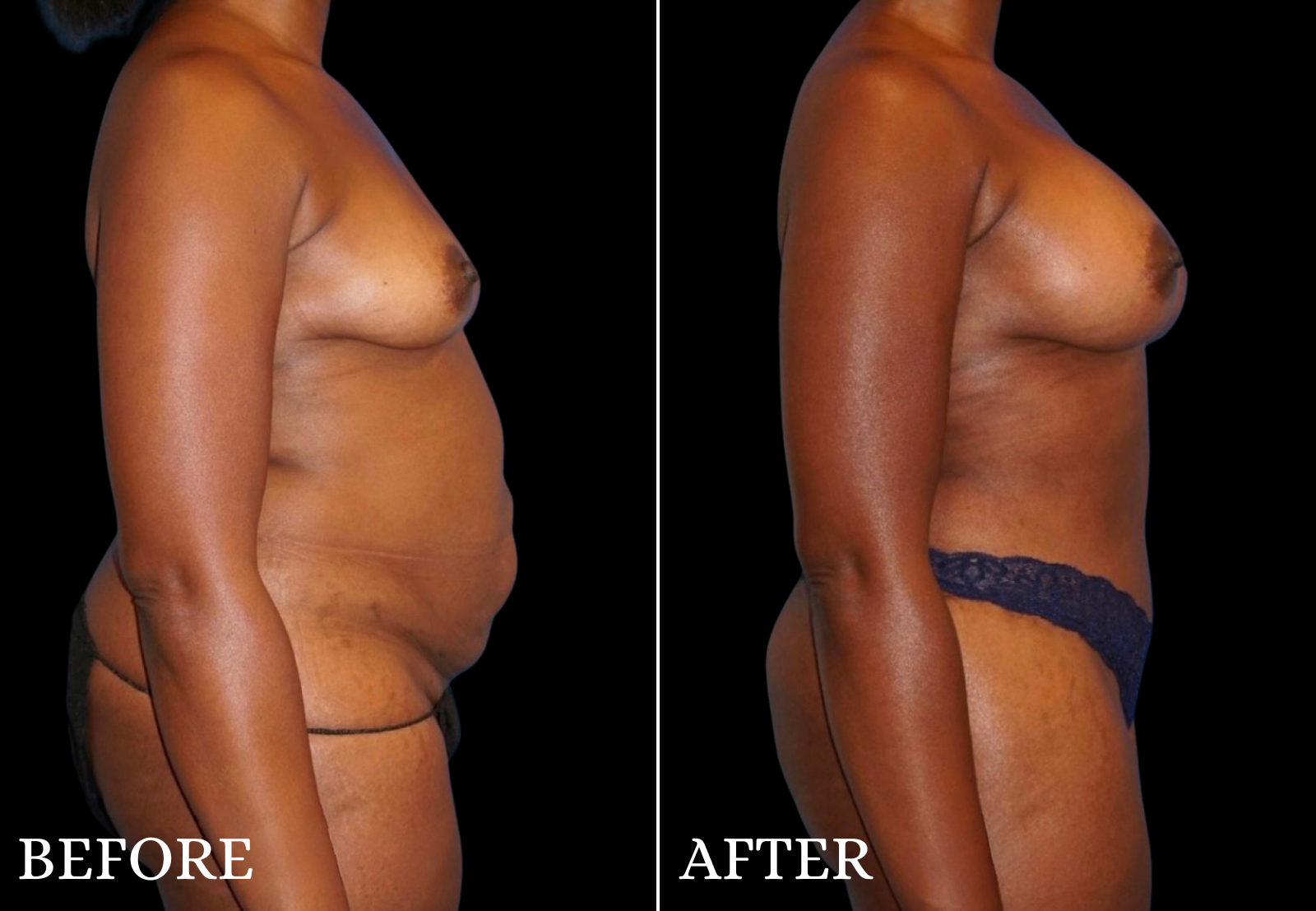 Tummy Tuck Before & After Gallery - Patient 305164 - Image 3