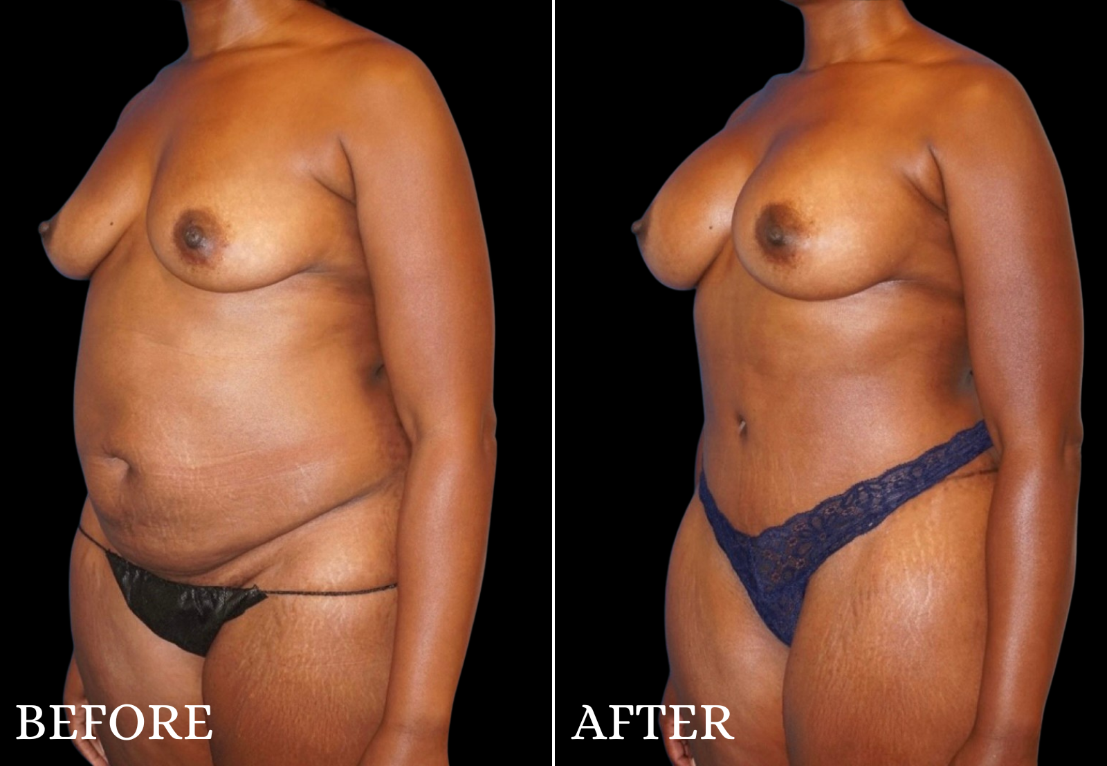 Tummy Tuck Before & After Gallery - Patient 305164 - Image 4
