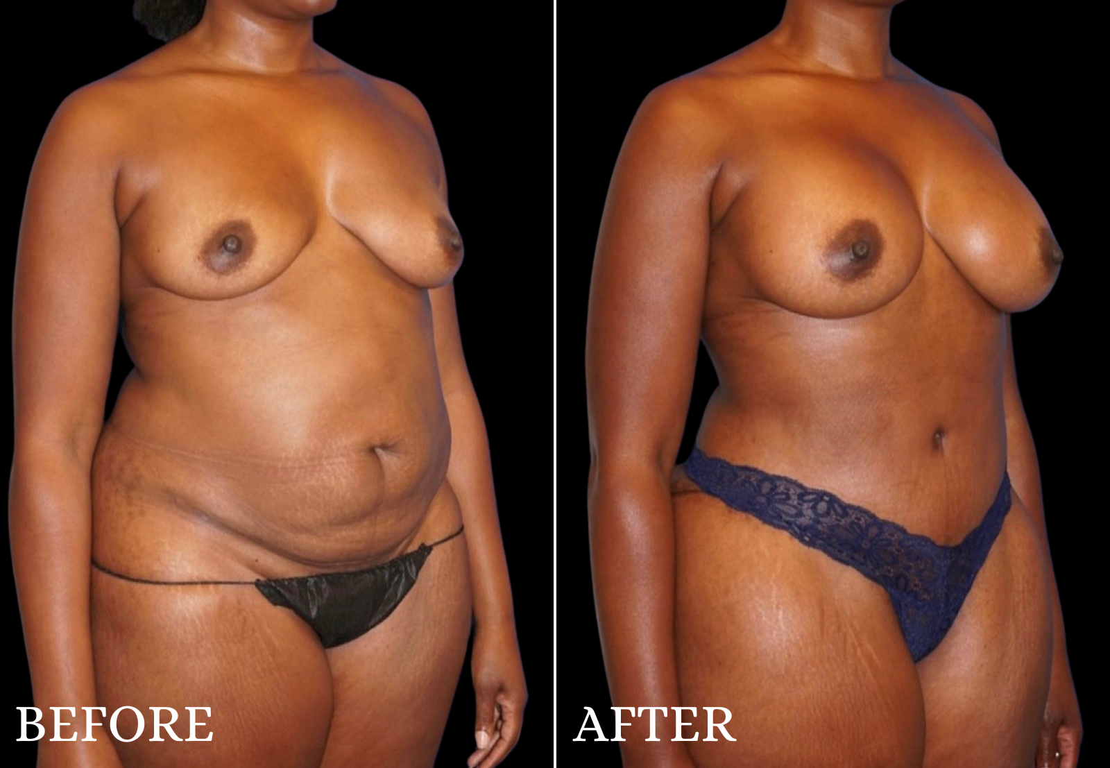 Tummy Tuck Before & After Gallery - Patient 305164 - Image 2