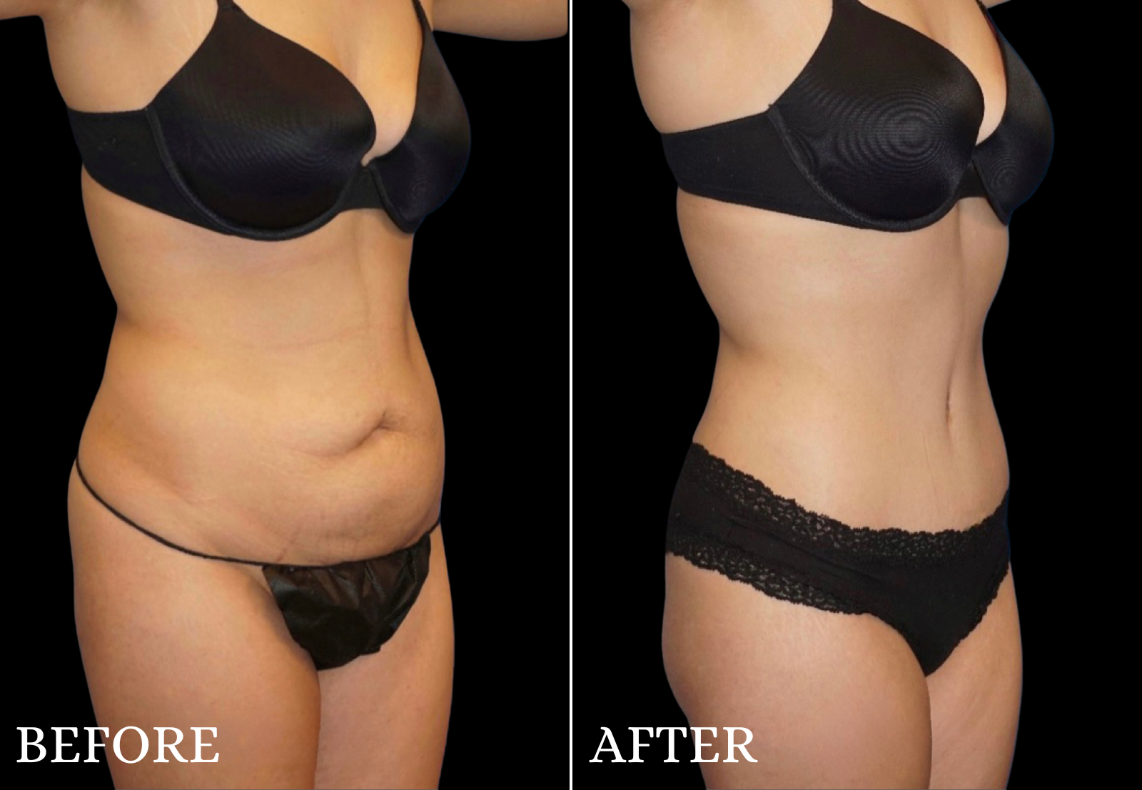Tummy Tuck Before & After Gallery - Patient 363325 - Image 2