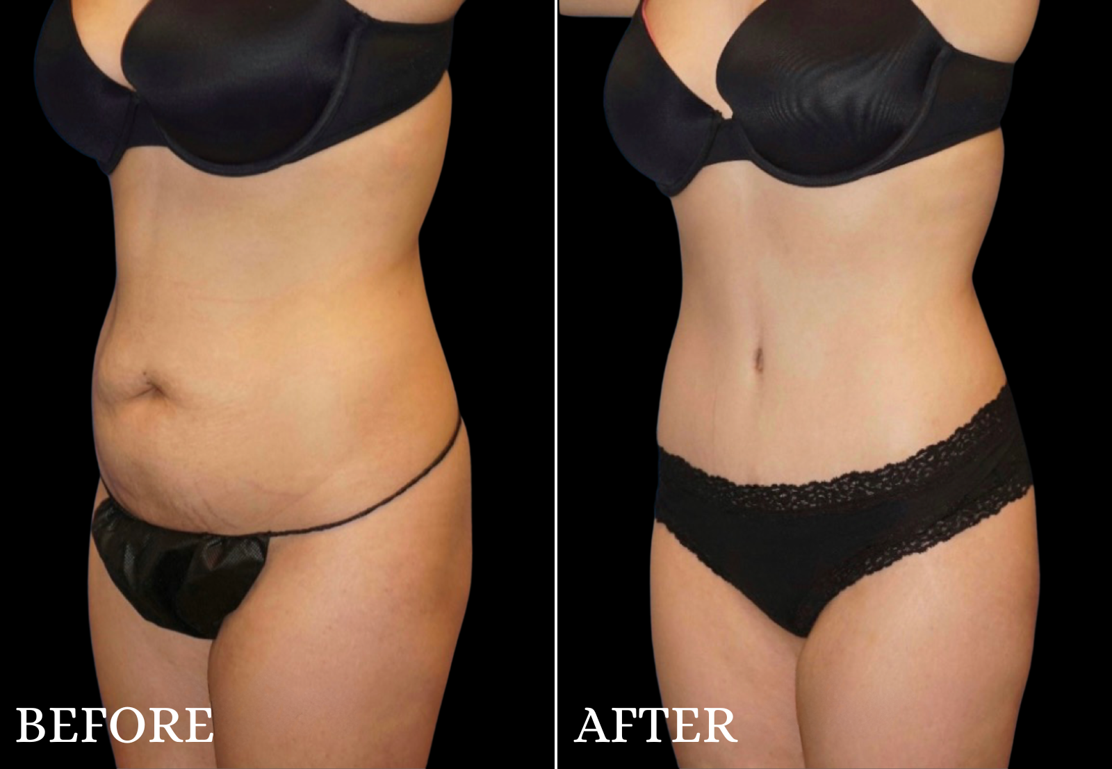 Tummy Tuck Before & After Gallery - Patient 363325 - Image 4
