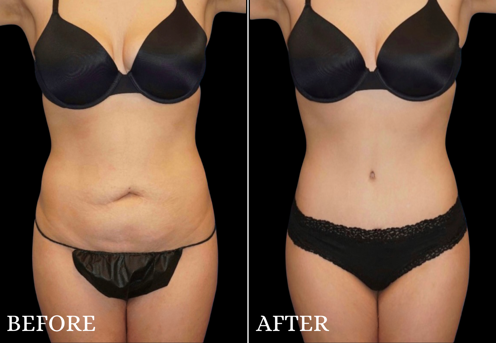 Tummy Tuck Before & After Gallery - Patient 363325 - Image 1
