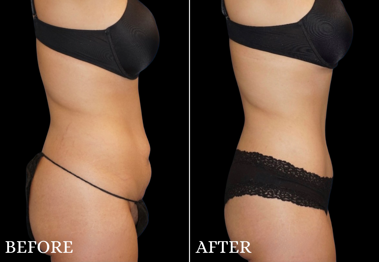 Tummy Tuck Before & After Gallery - Patient 363325 - Image 3