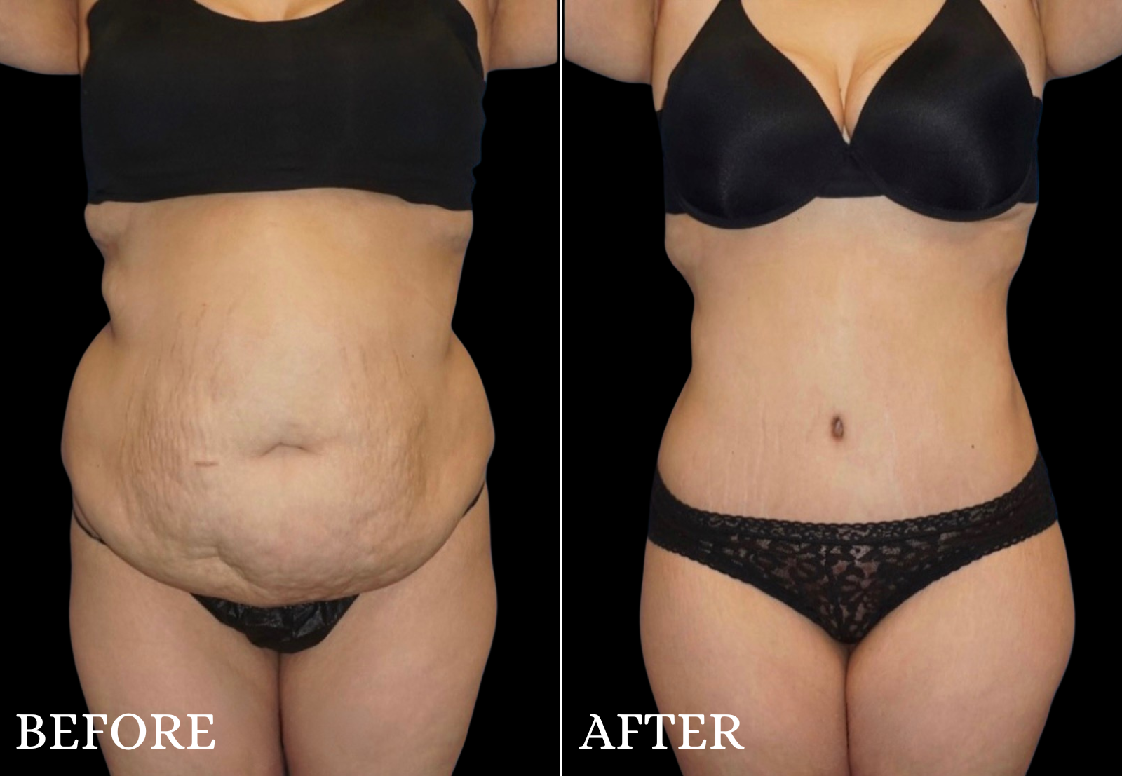Tummy Tuck Before & After Gallery - Patient 324043 - Image 1