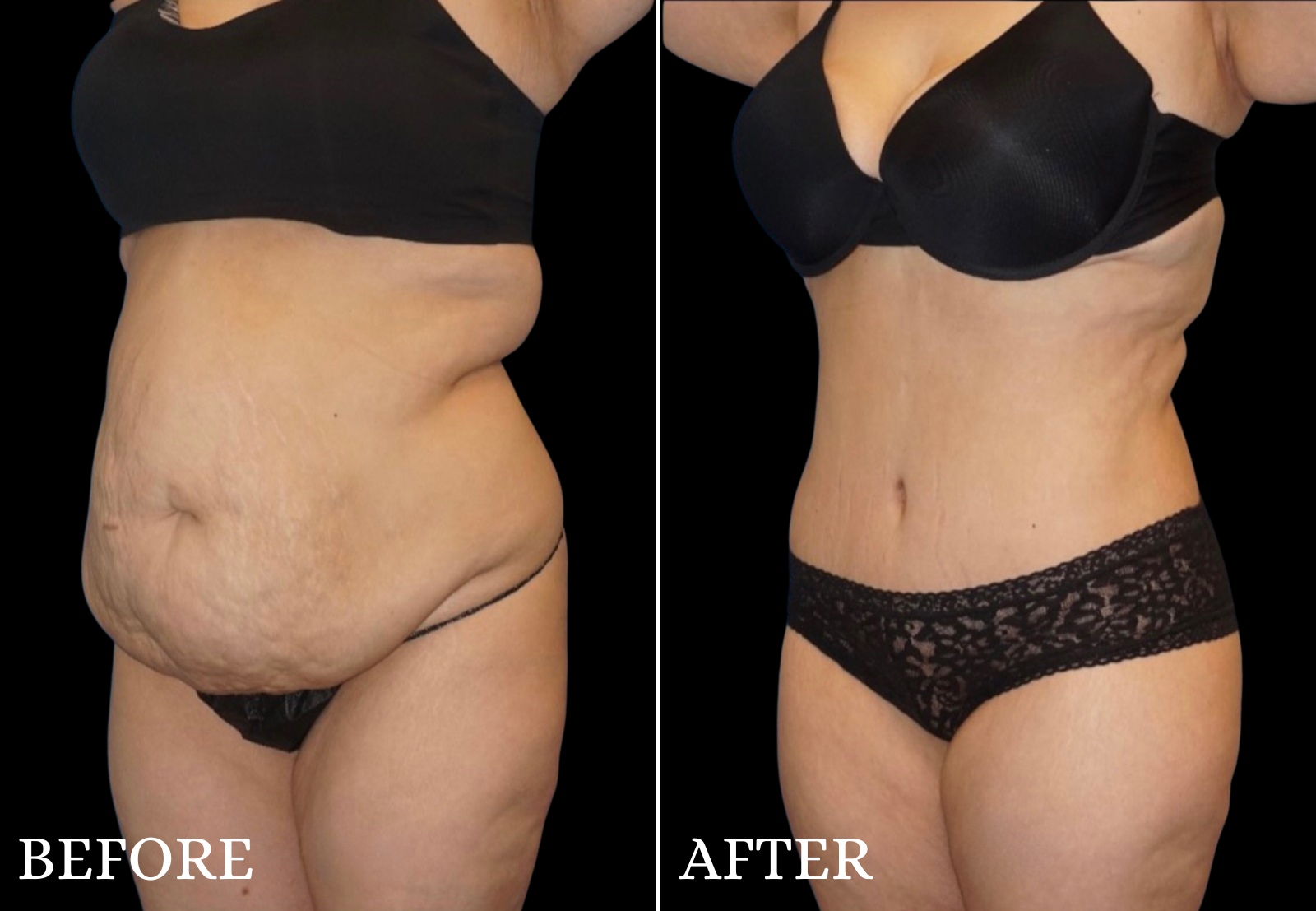 Liposuction Before & After Gallery - Patient 789731 - Image 2
