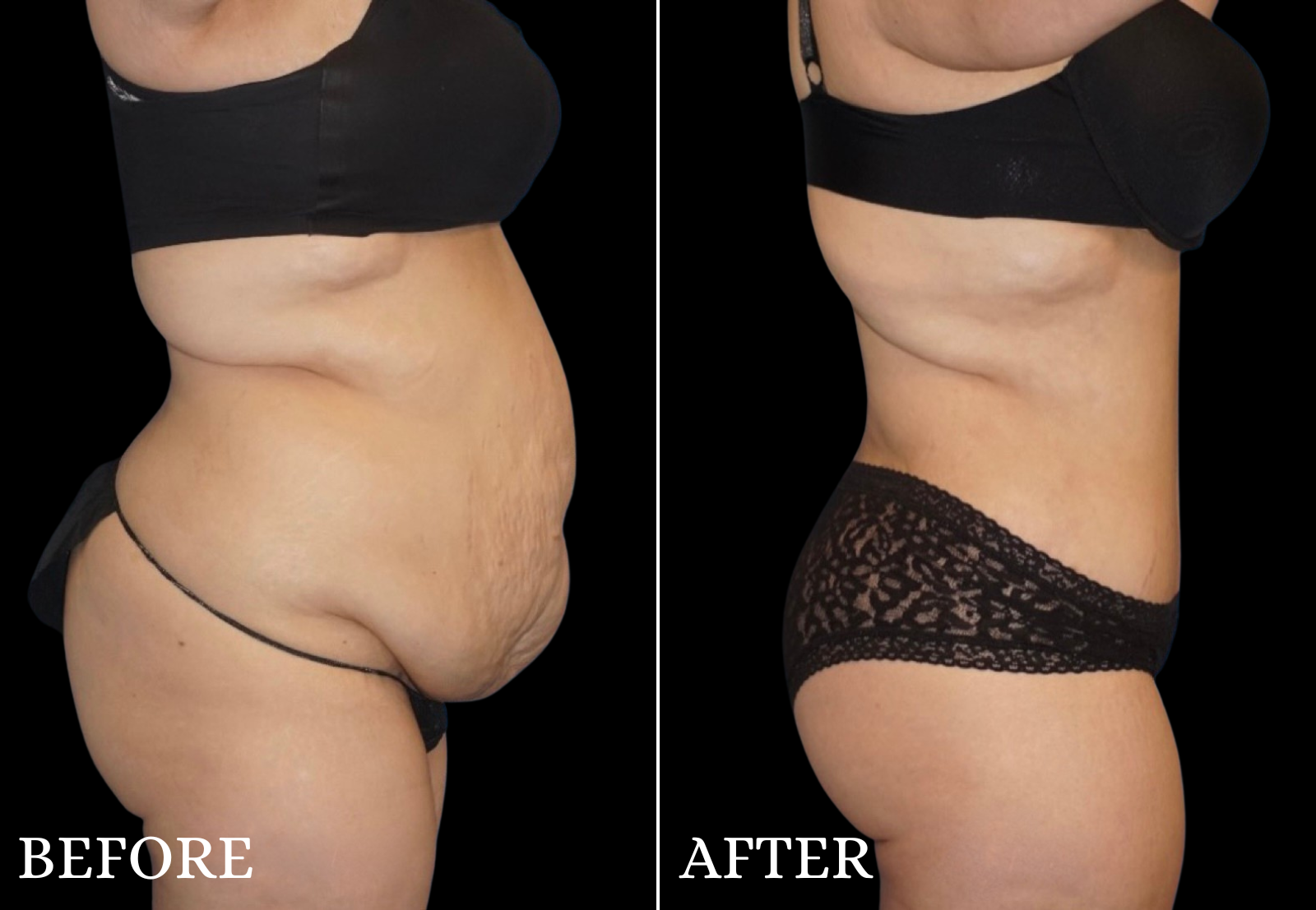 Liposuction Before & After Gallery - Patient 789731 - Image 4