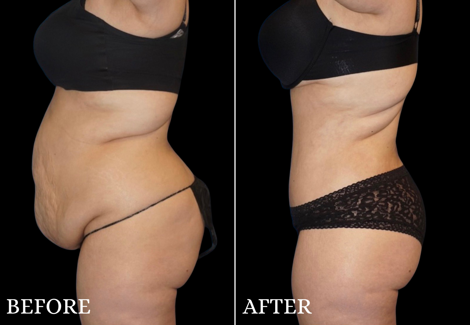 Liposuction Before & After Gallery - Patient 789731 - Image 3