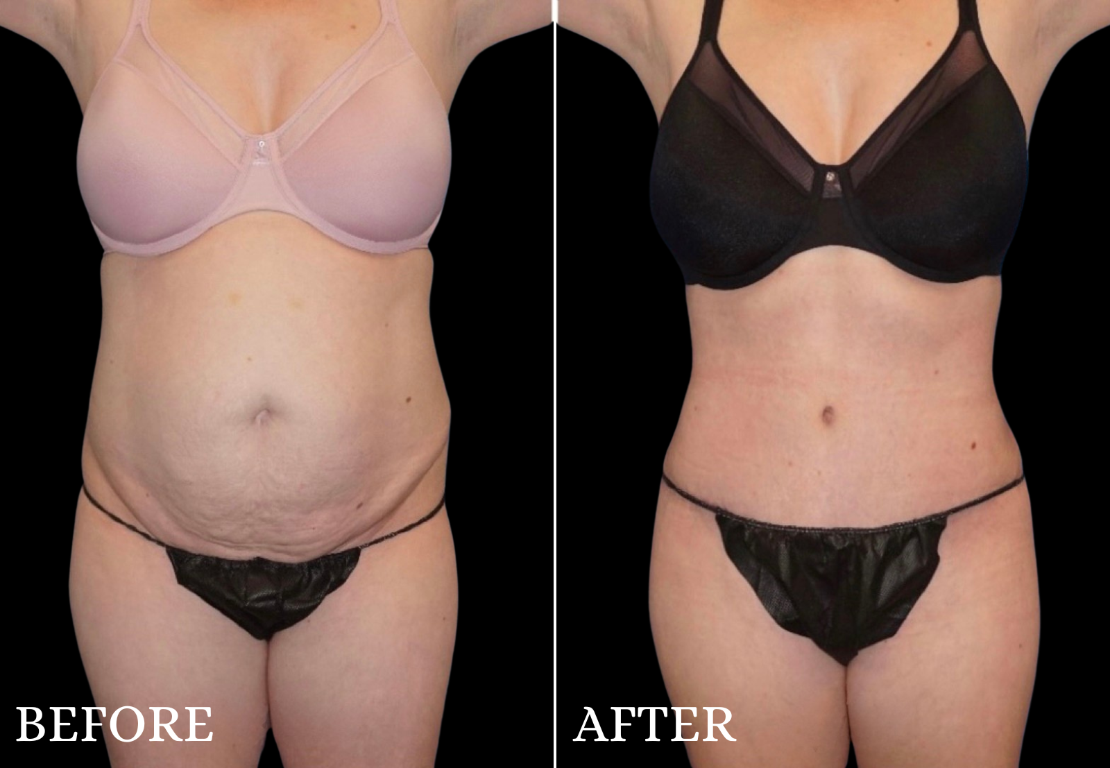 Tummy Tuck Before & After Gallery - Patient 214722 - Image 1