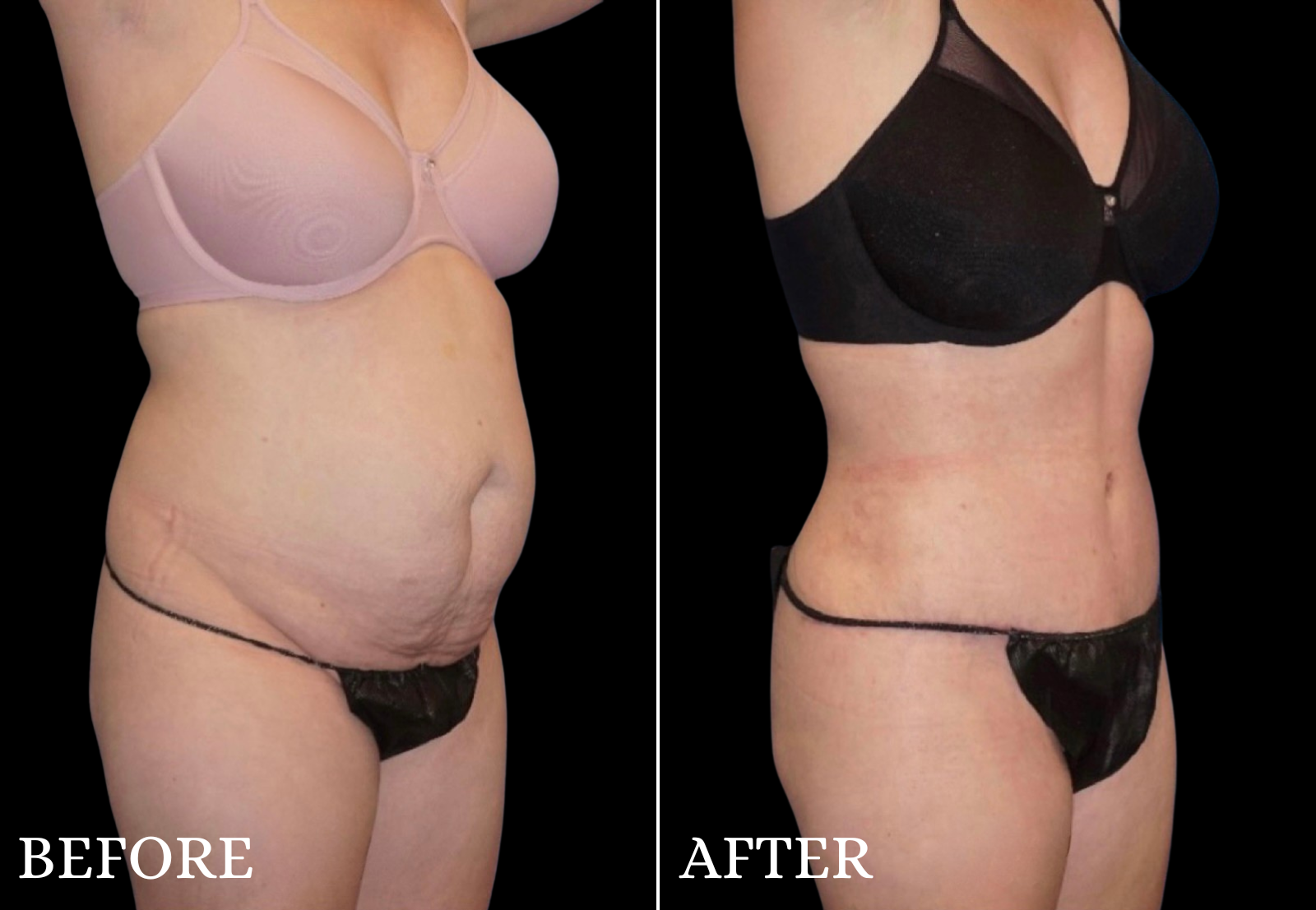 Tummy Tuck Before & After Gallery - Patient 214722 - Image 2