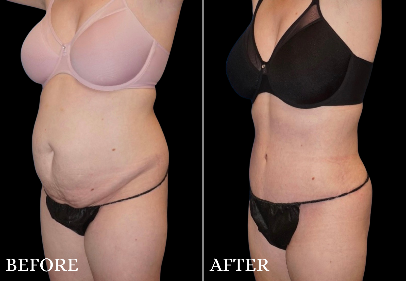 Tummy Tuck Before & After Gallery - Patient 214722 - Image 3