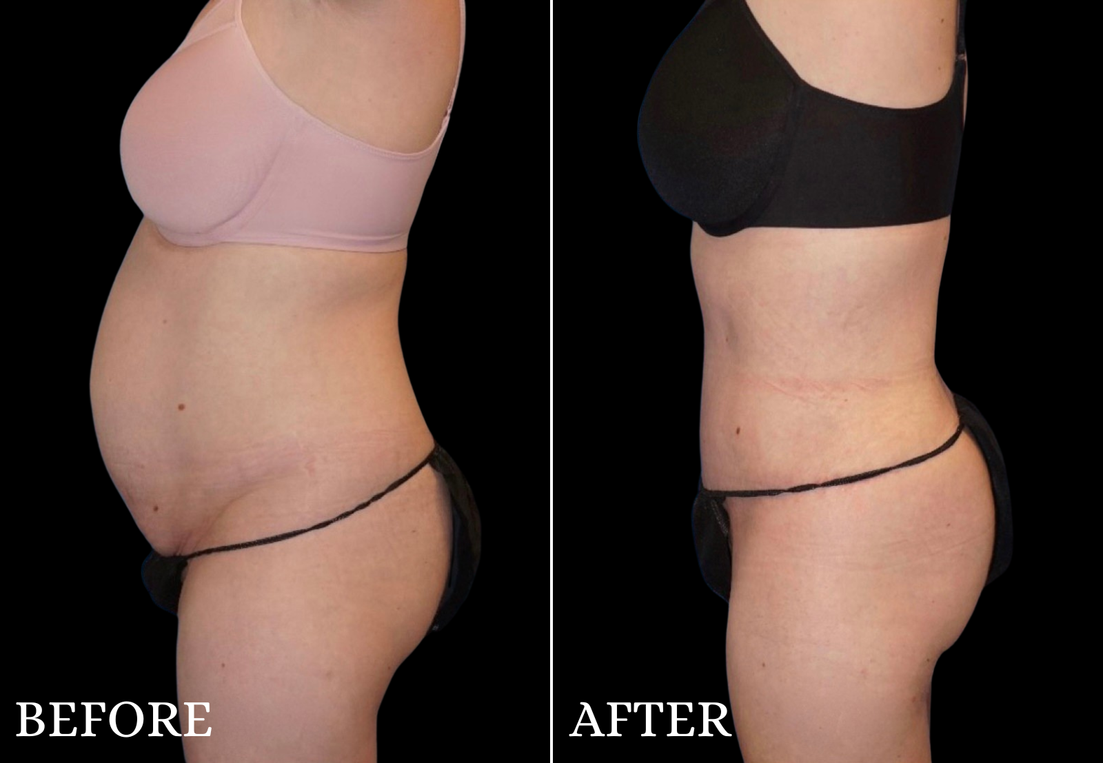 Tummy Tuck Before & After Gallery - Patient 214722 - Image 4