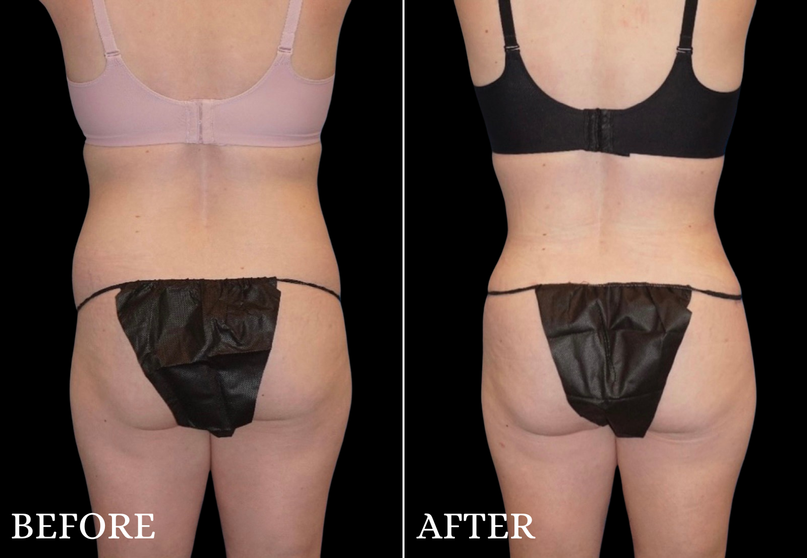 Tummy Tuck Before & After Gallery - Patient 214722 - Image 5