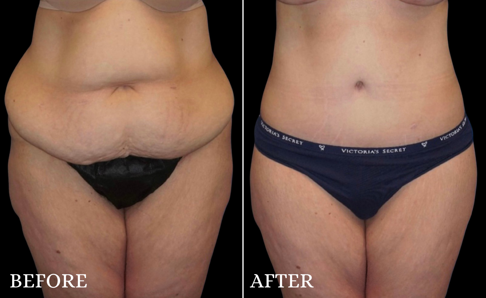 Tummy Tuck Before & After Gallery - Patient 439788 - Image 1