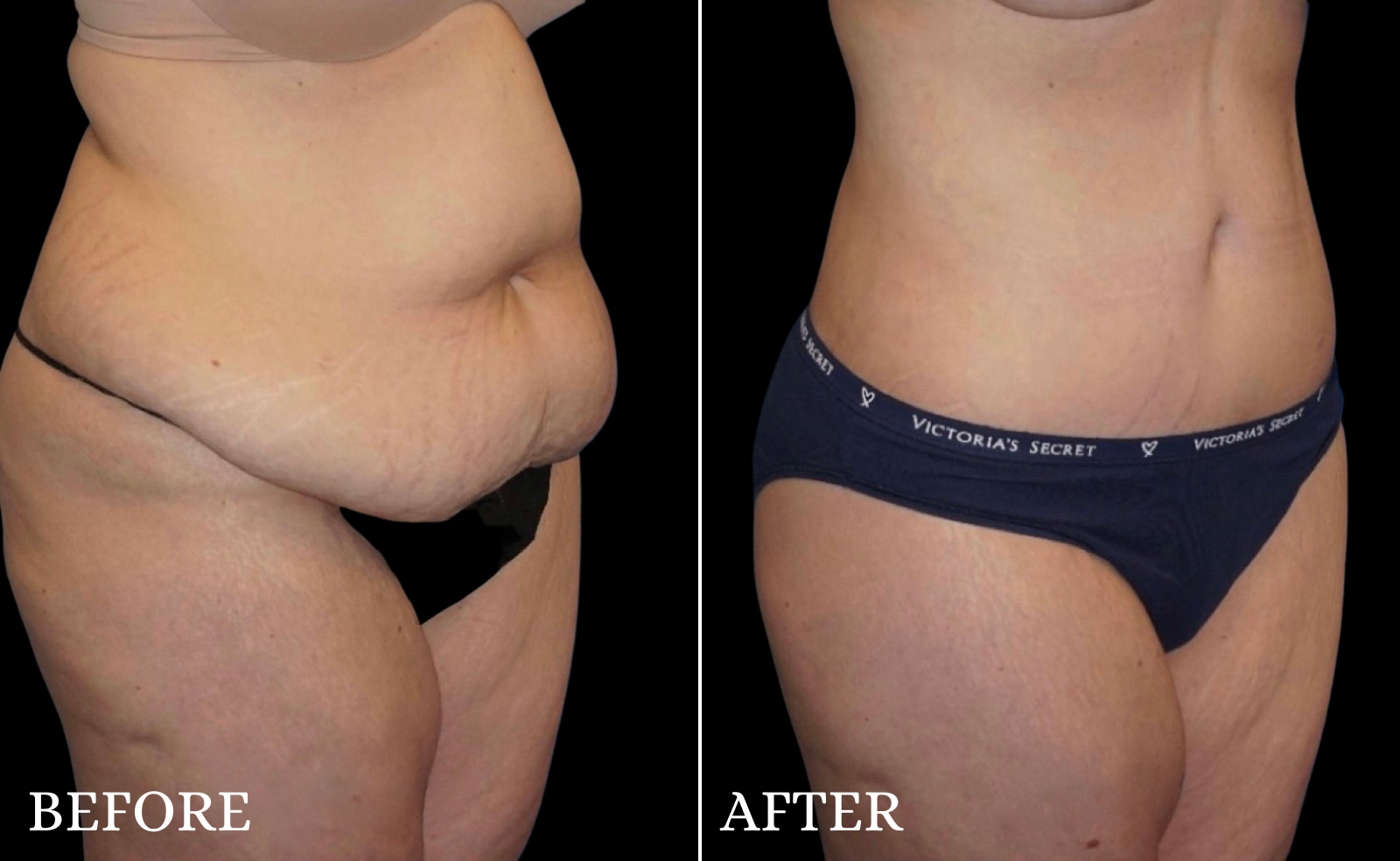 Tummy Tuck Before & After Gallery - Patient 439788 - Image 2