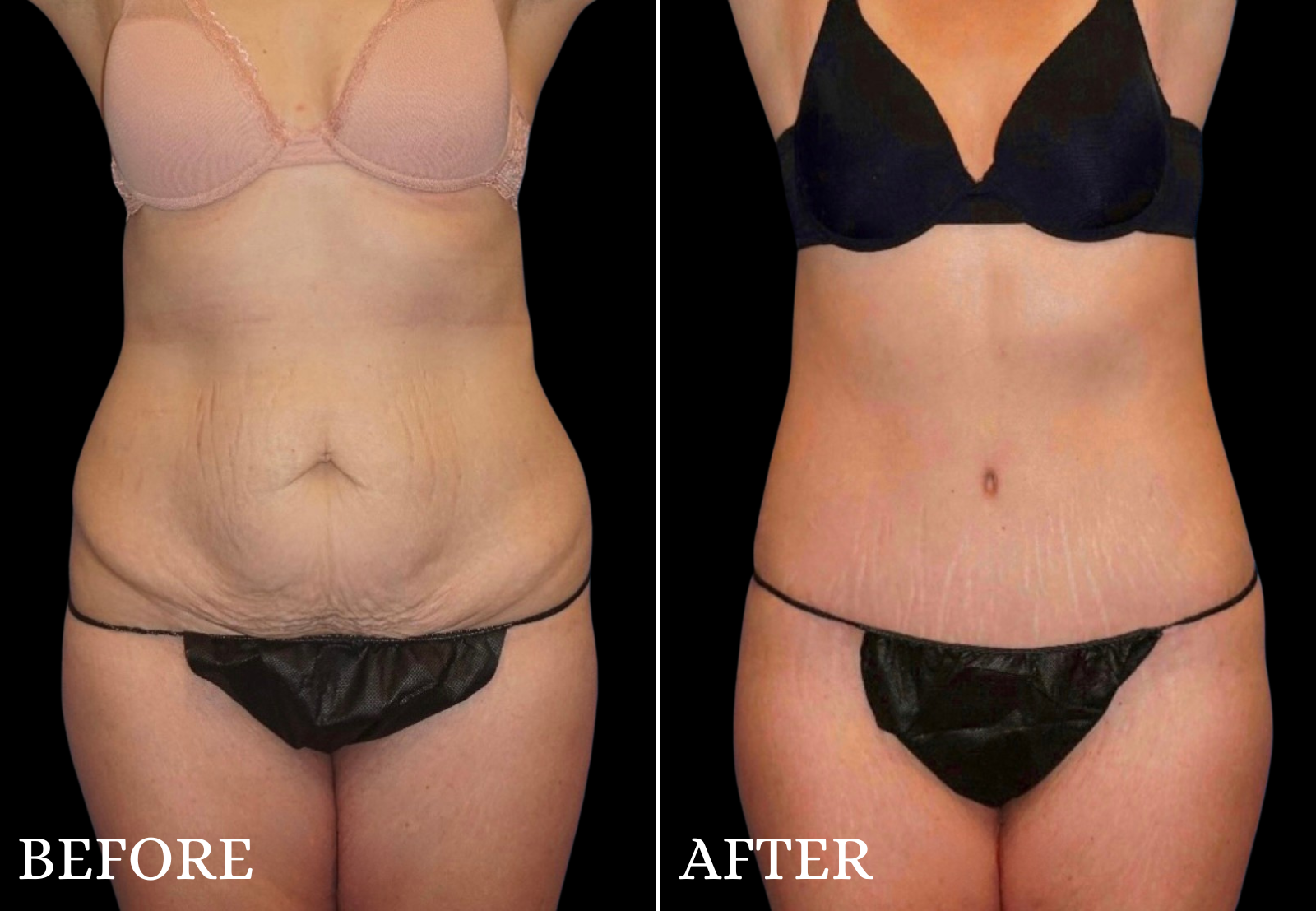 Tummy Tuck Before & After Gallery - Patient 234961 - Image 1