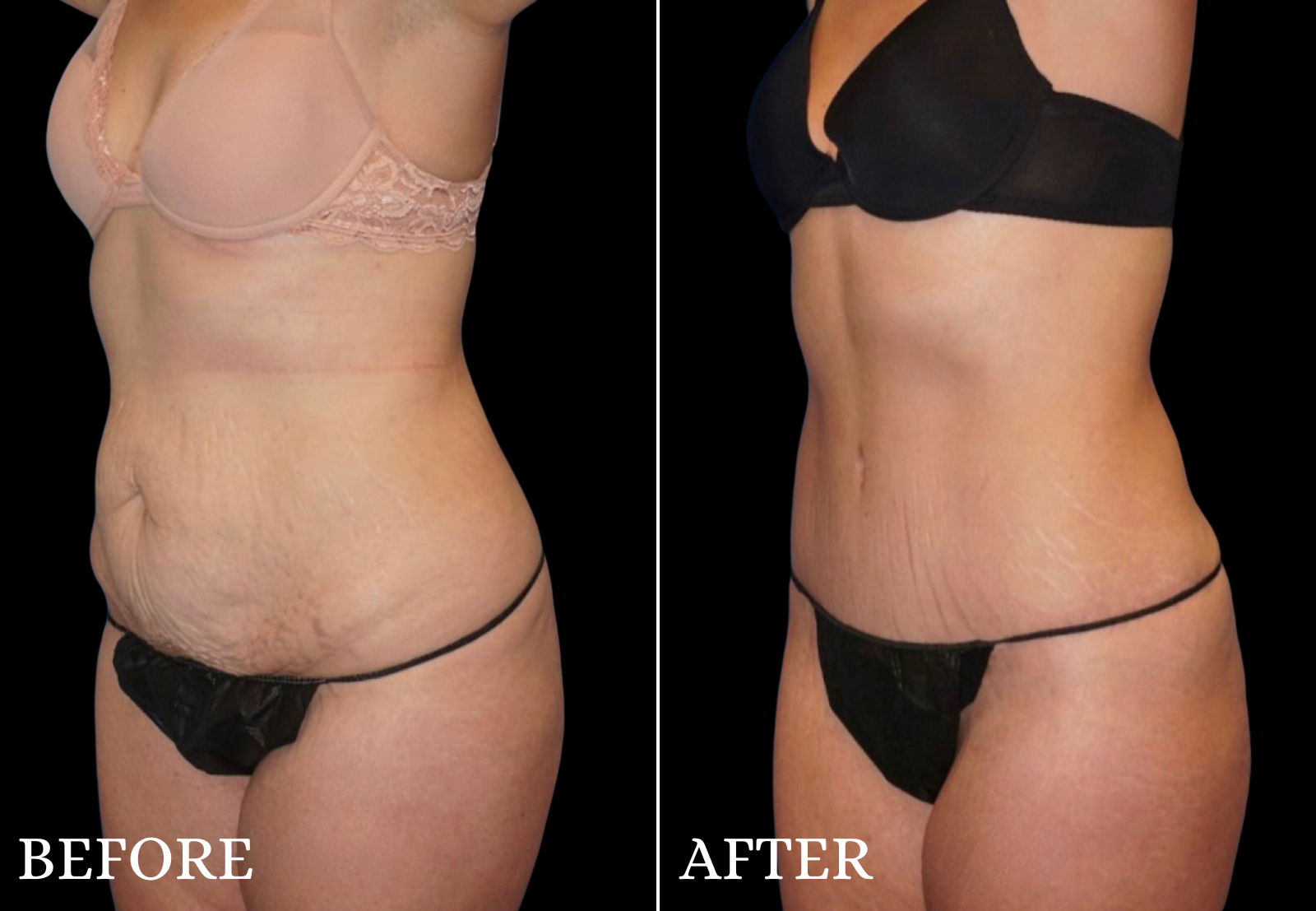 Tummy Tuck Before & After Gallery - Patient 234961 - Image 4