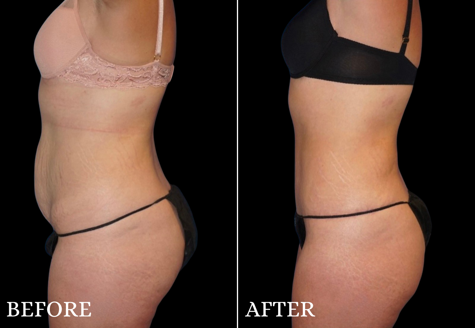 Tummy Tuck Before & After Gallery - Patient 234961 - Image 5