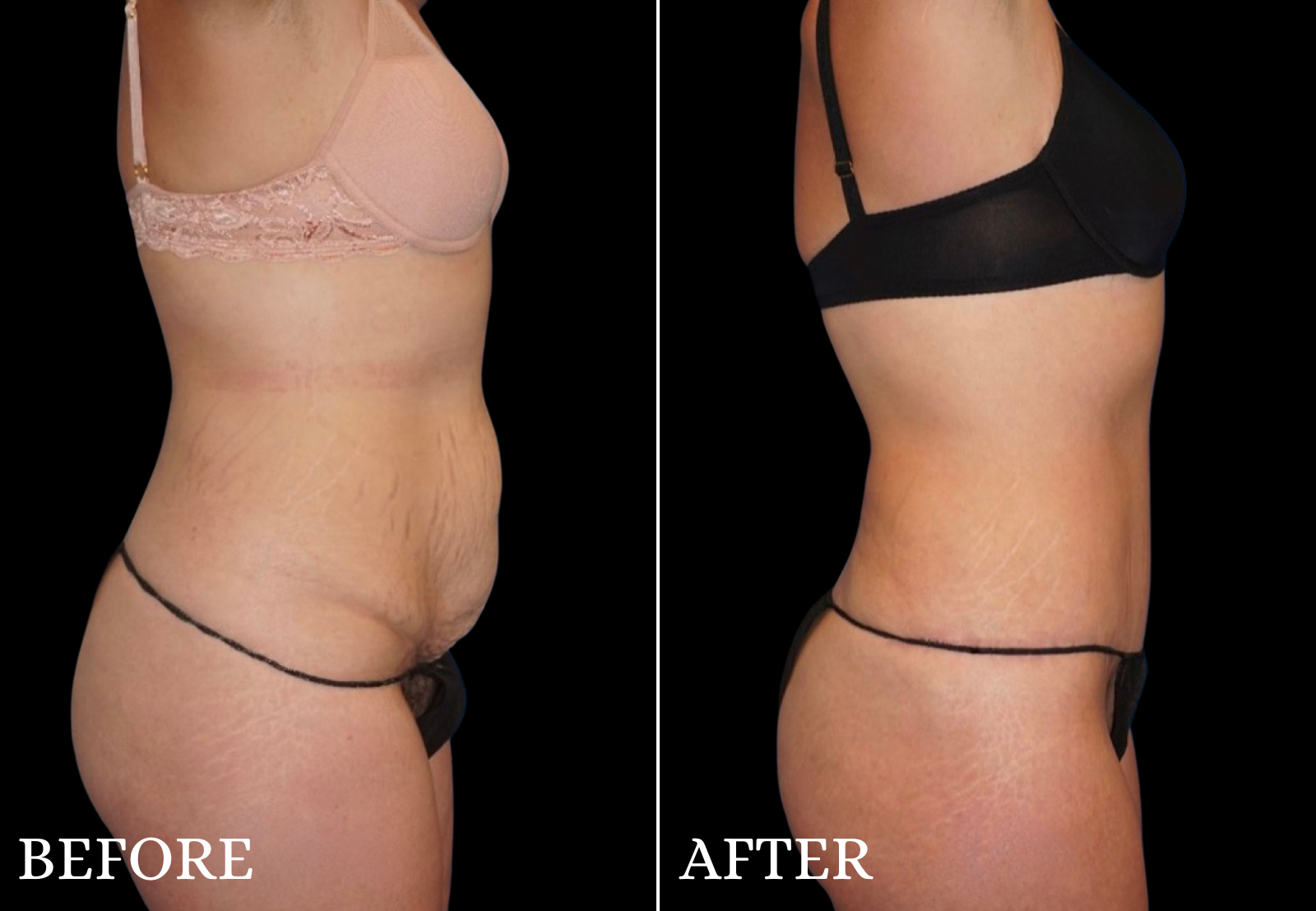 Tummy Tuck Before & After Gallery - Patient 234961 - Image 3
