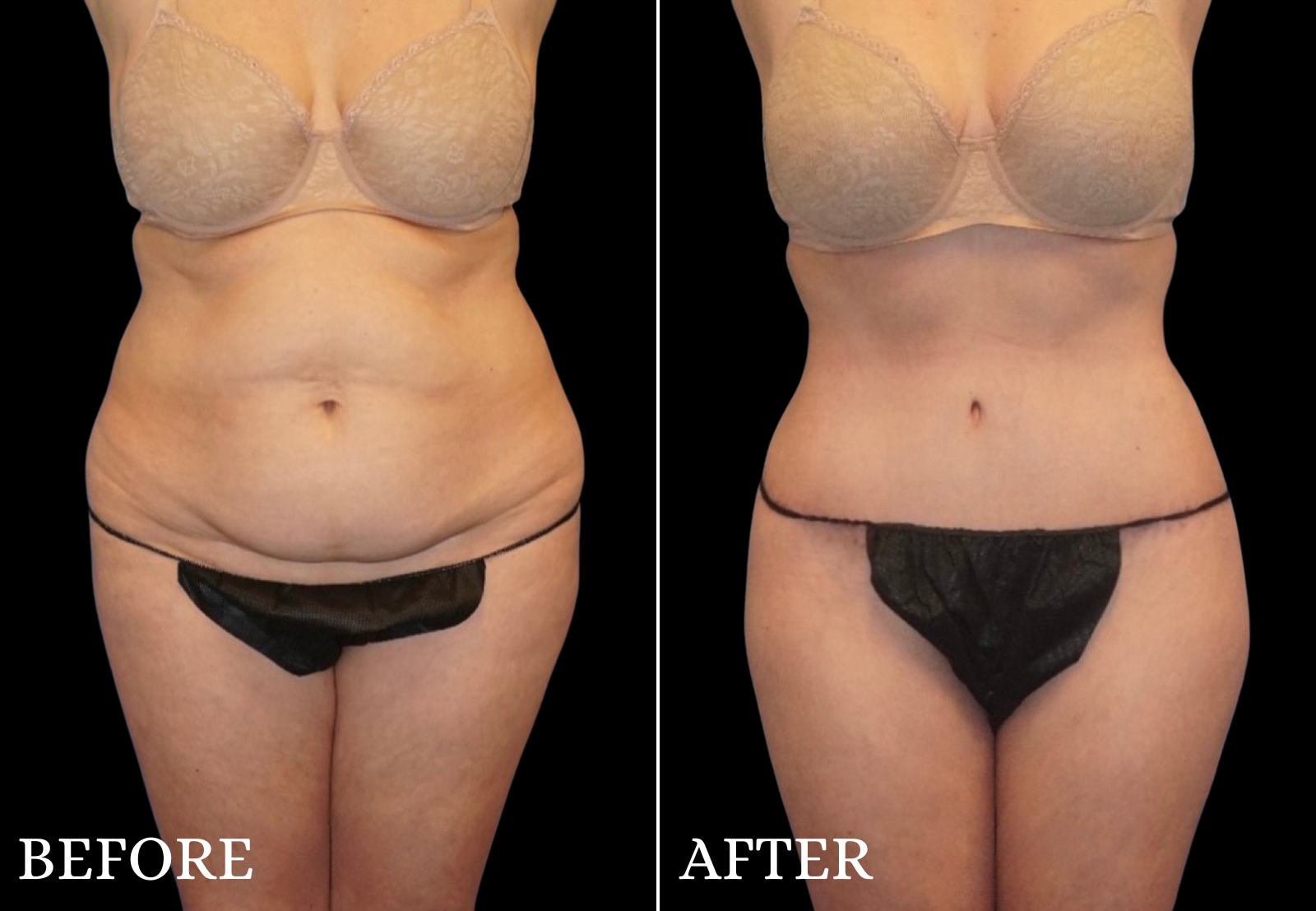 Tummy Tuck Before & After Gallery - Patient 334419 - Image 1