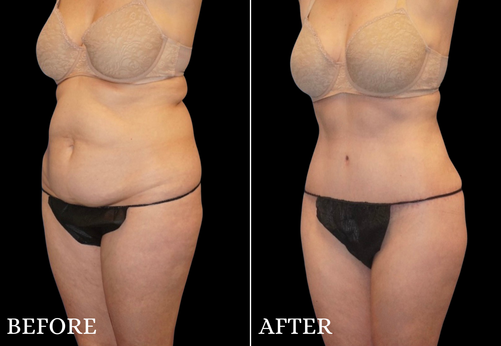 Tummy Tuck Before & After Gallery - Patient 334419 - Image 3