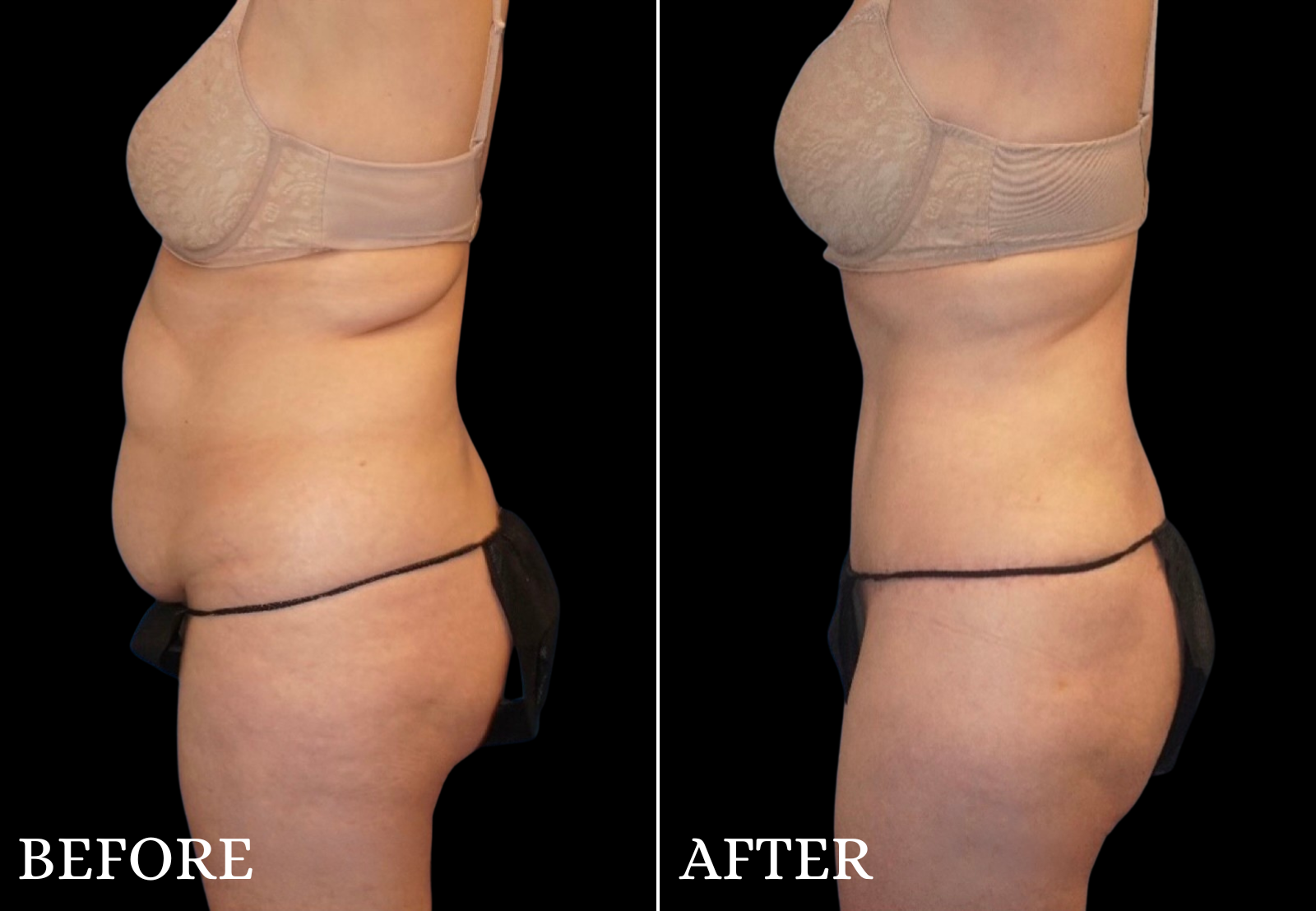 Tummy Tuck Before & After Gallery - Patient 334419 - Image 2