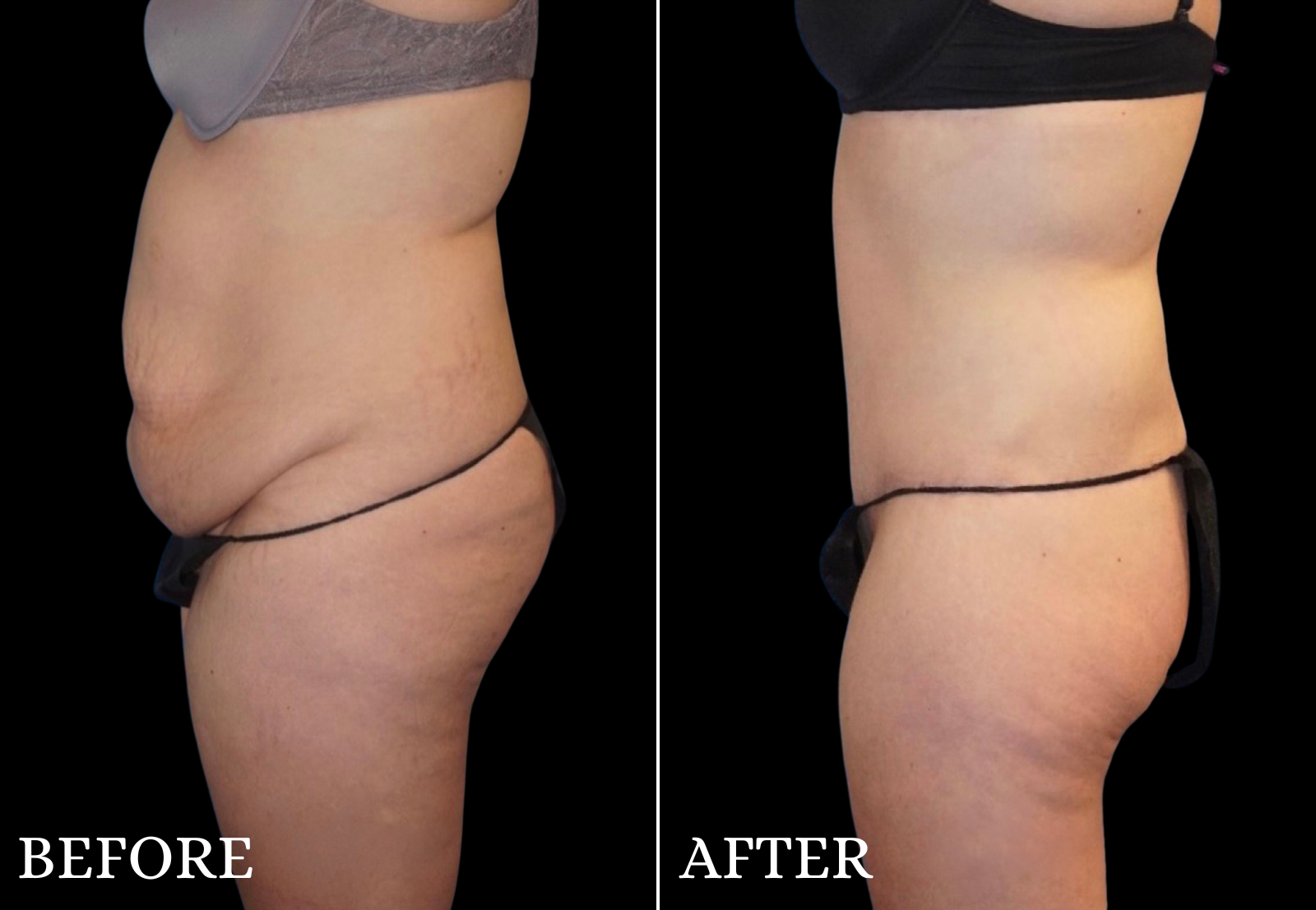 Tummy Tuck Before & After Gallery - Patient 229703 - Image 4