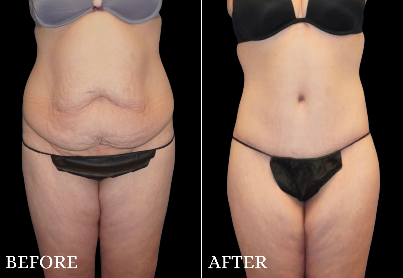 Tummy Tuck Before & After Gallery - Patient 229703 - Image 1